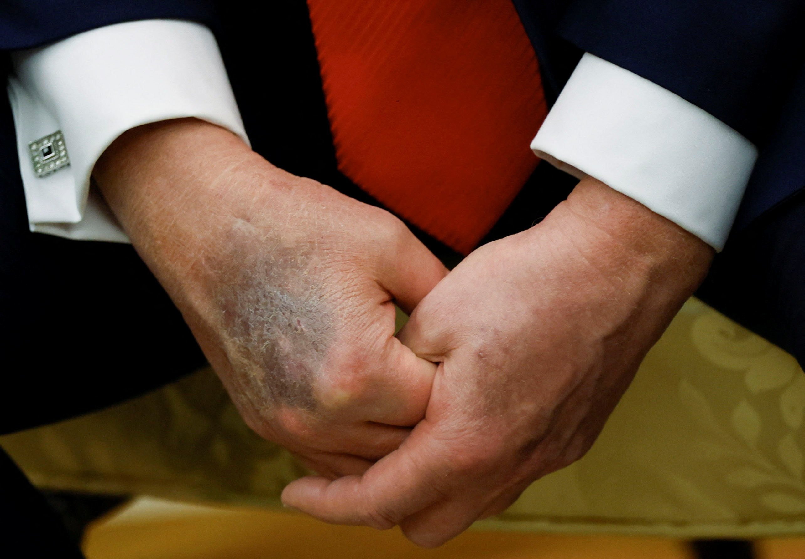 The bruised right hand of US President Donald Trump is visible during a meeting with South Korean President Lee Jae-myung at the White House on August 25. Photo: Reuters