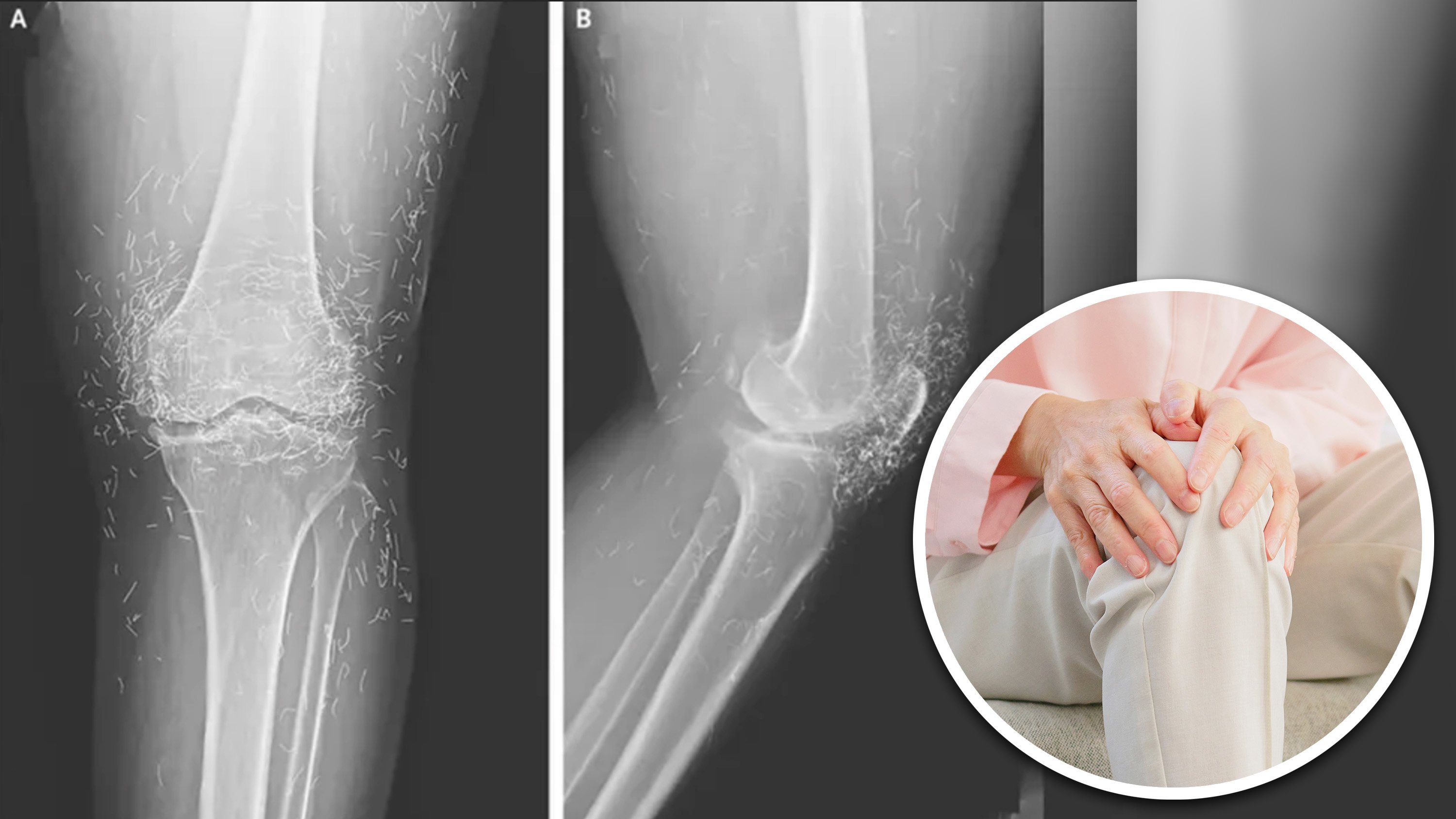 Golden thread acupuncture involves embedding tiny gold wires in acupuncture points to purportedly provide continuous pain relief, which is popular in some Asian regions. Photo: SCMP composite/Shutterstock/The New England Journal of Medicine