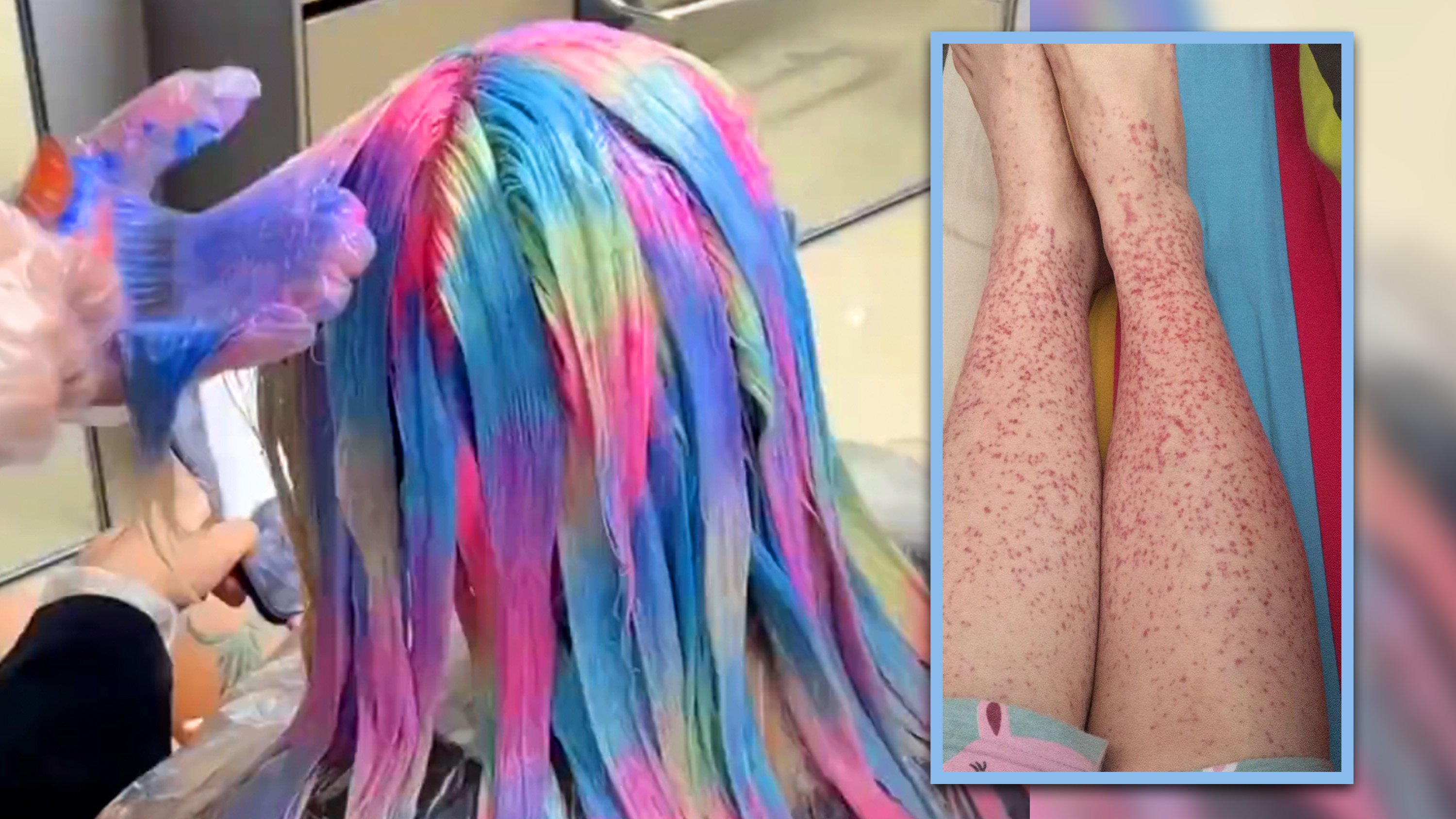 A 20-year-old Chinese woman who dyed her hair monthly to match that of her favourite star has suffered kidney disease due to harmful chemicals in the dye. Photo: SCMP c omposite/Douyin/Sohu