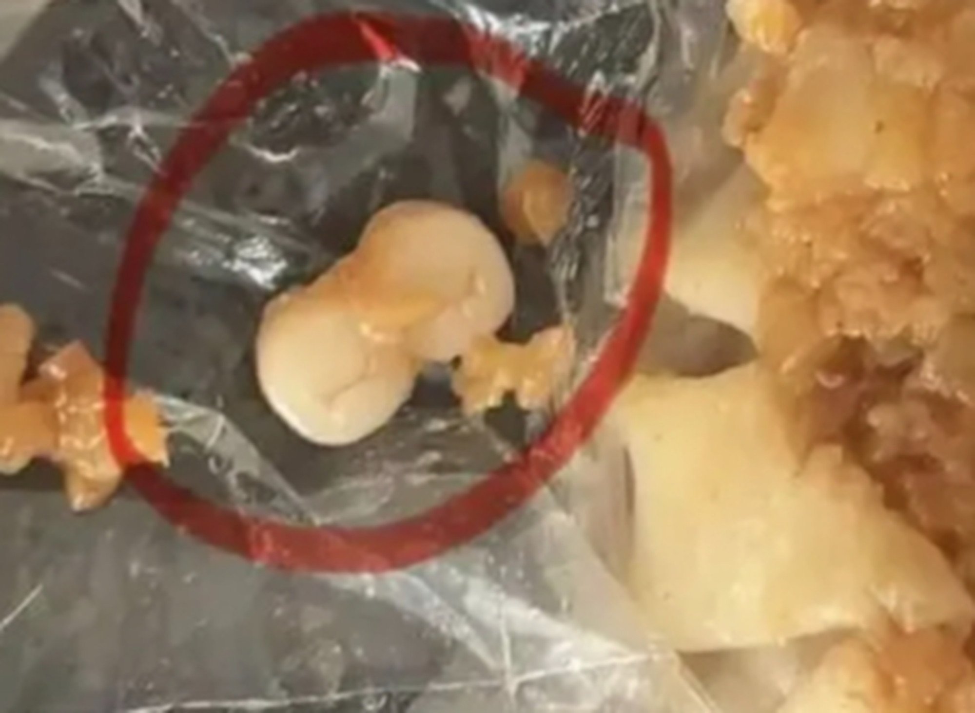 Another woman shared that her father found two human teeth in dim sum at a branch of a well-known local chain in Dongguan City, in southern Guangdong province. Photo: Weibo Another woman shared that her father found two human teeth in dim sum at a branch of a well-known local chain in Dongguan City, in southern Guangdong province. Photo: Weibo