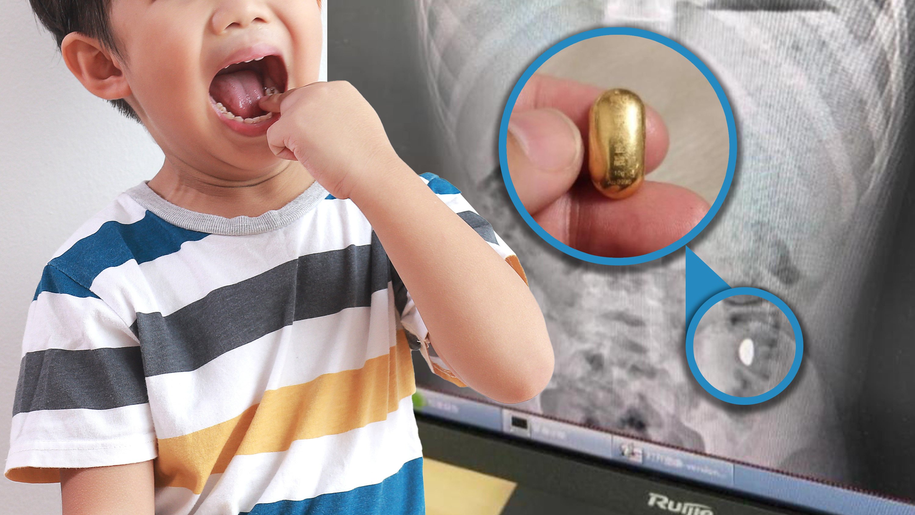 An 11-year-old Chinese boy accidentally swallowed a gold bead worth US$1,400 which had to be retrieved with the help of doctors. Photo: Shutterstock/Baidu