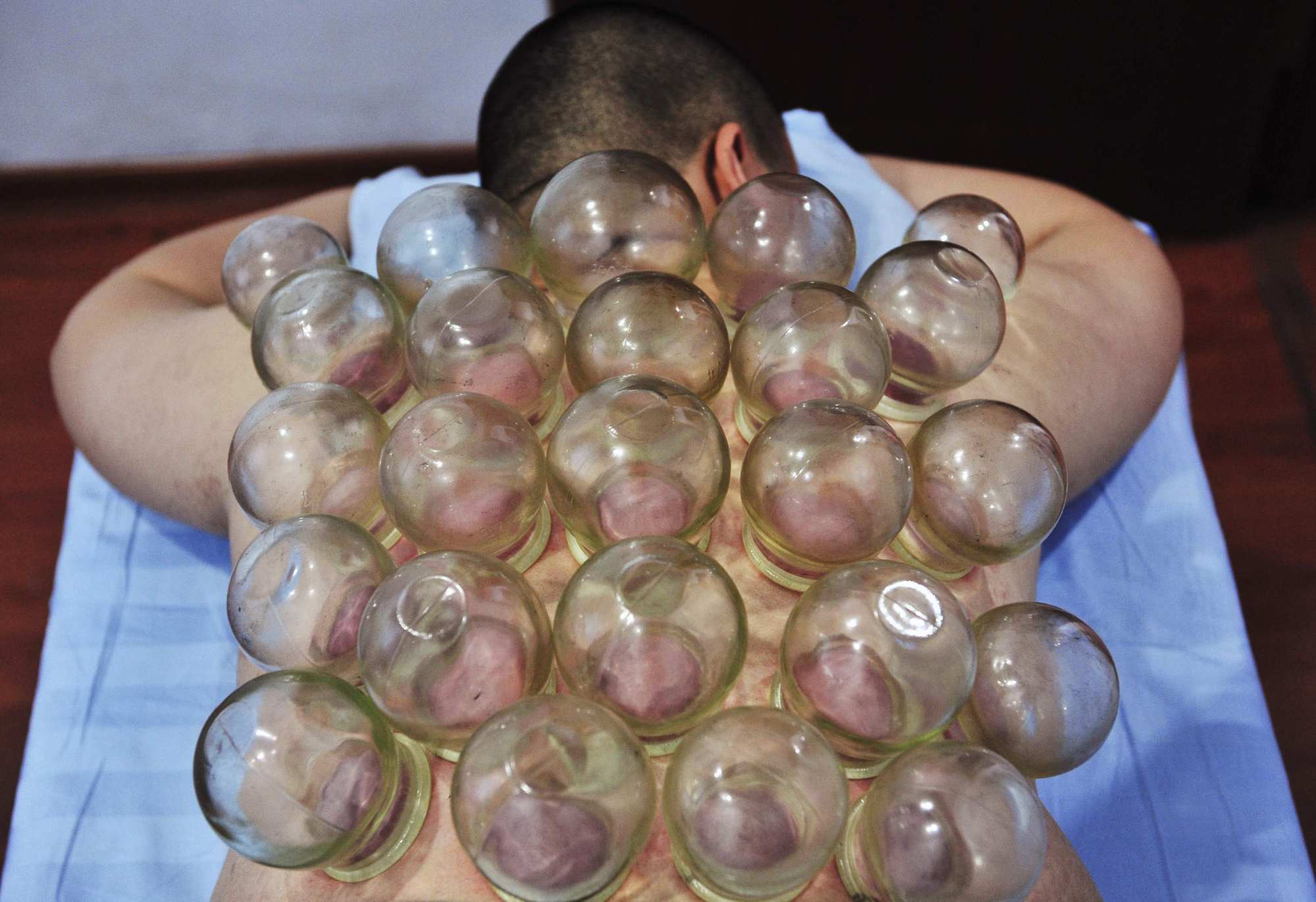 A patient receives cupping treatment at a weight loss centre in Changchun, Jilin province, where this practice is believed to enhance blood flow and promote healing. Photo: Reuters/Sheng Li