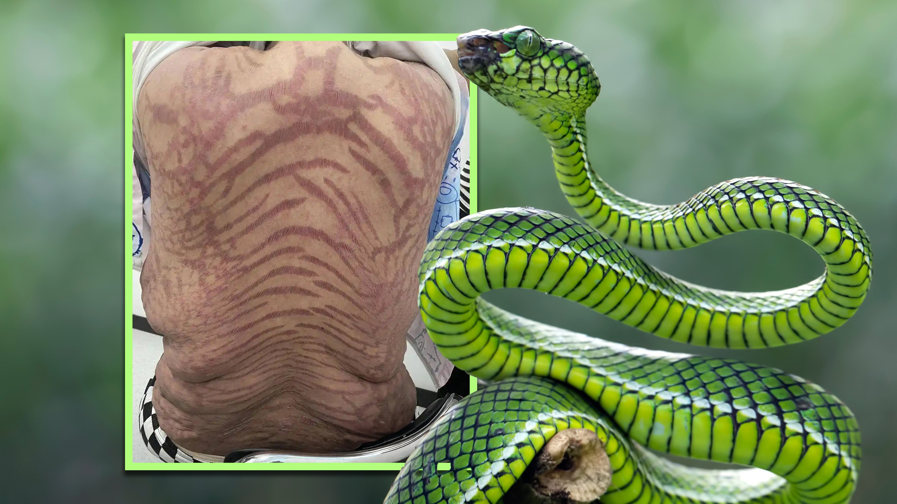 After using a well-known ointment claimed to be a “pure traditional Chinese medicine” for 10 years, a Chinese woman developed snake-like patterns across her body. Photo: Shutterstock/Douyin