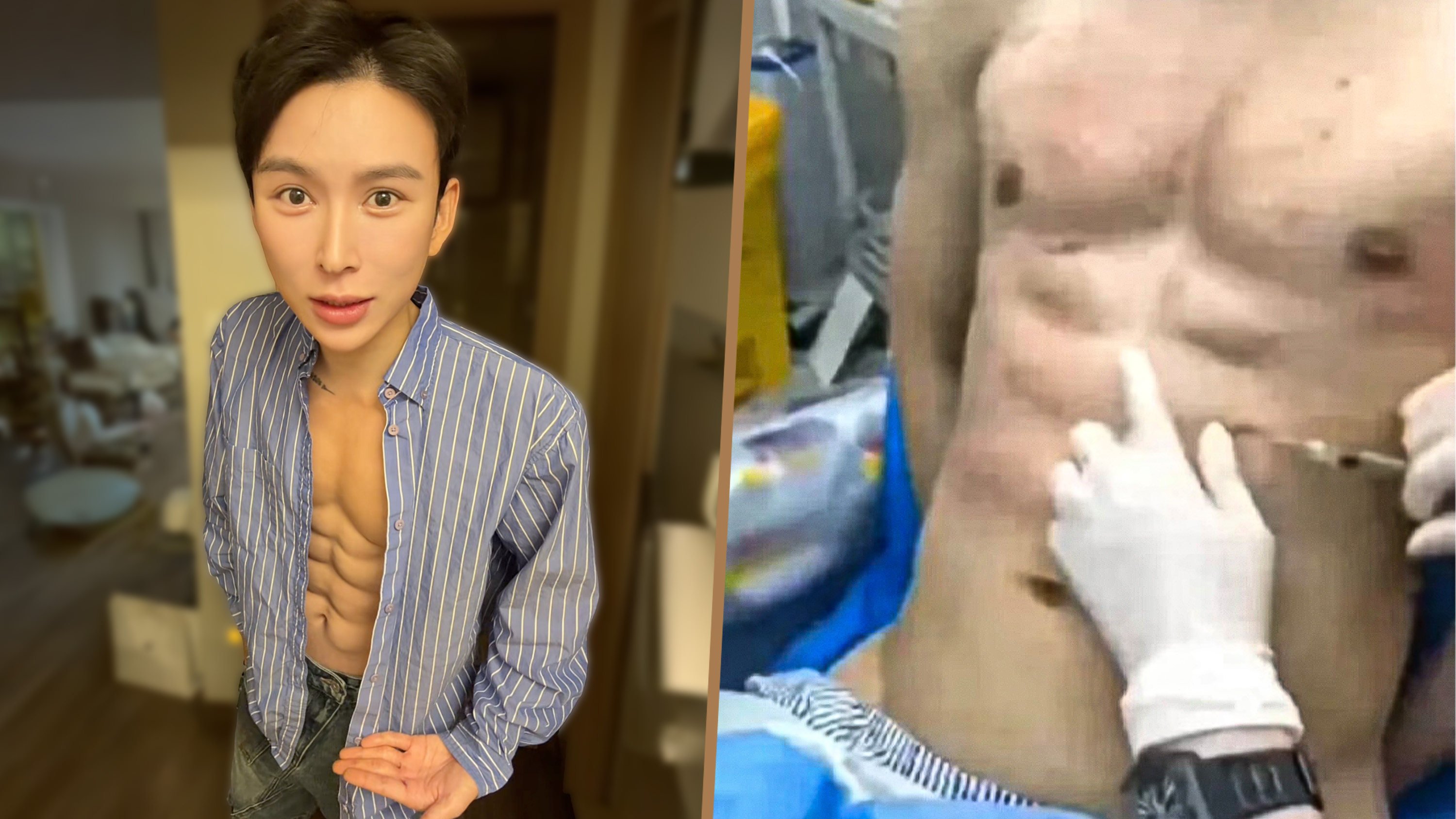 A Chinese man has sparked controversy by spending US$560,000 on acid injections to achieve artificial abs. Photo: Douyin