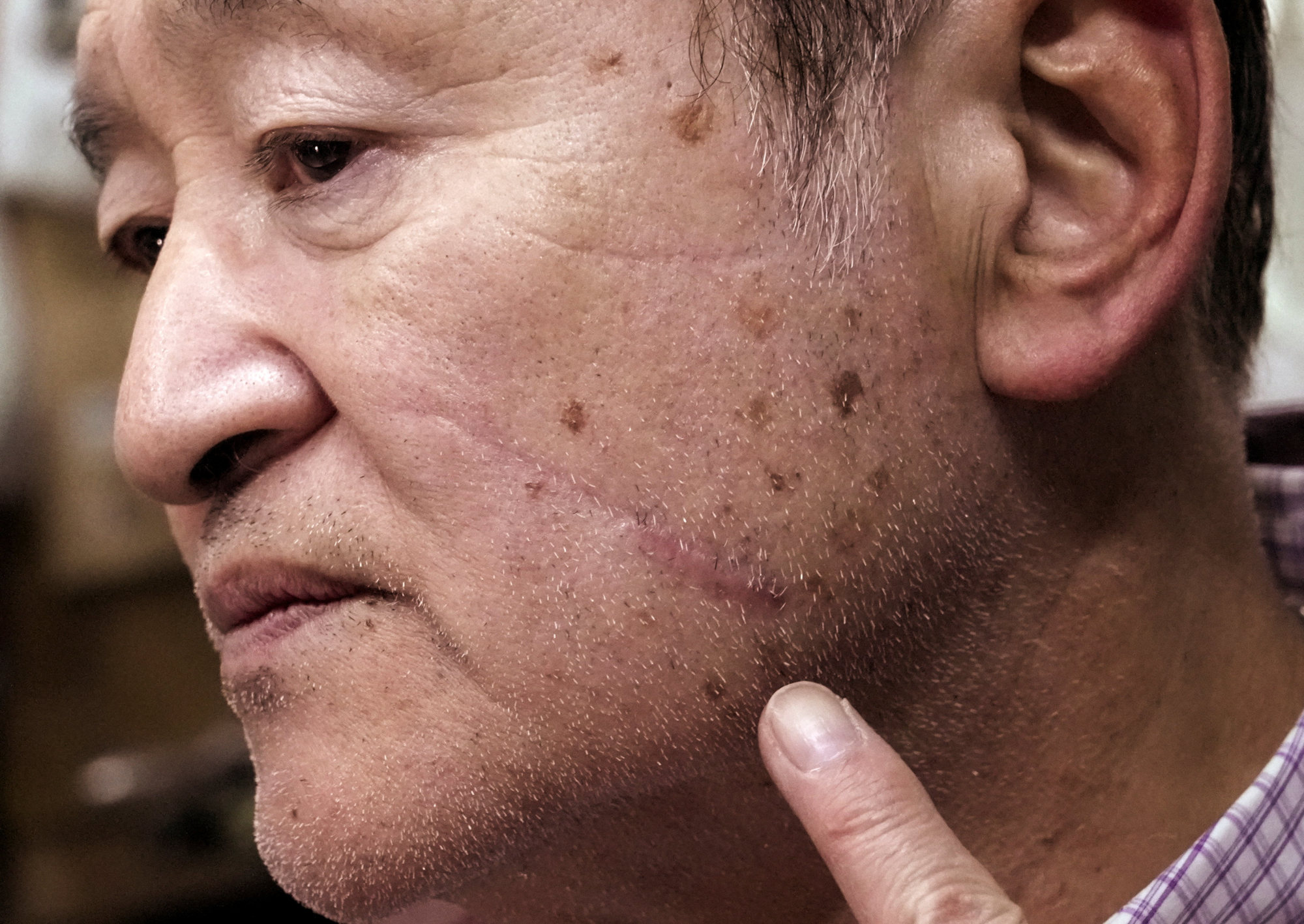 Keiji Minatoya, 68, points to a scar on his face from when he was attacked by a bear in 2023. Photo: Reuters Keiji Minatoya, 68, points to a scar on his face from when he was attacked by a bear in 2023. Photo: Reuters