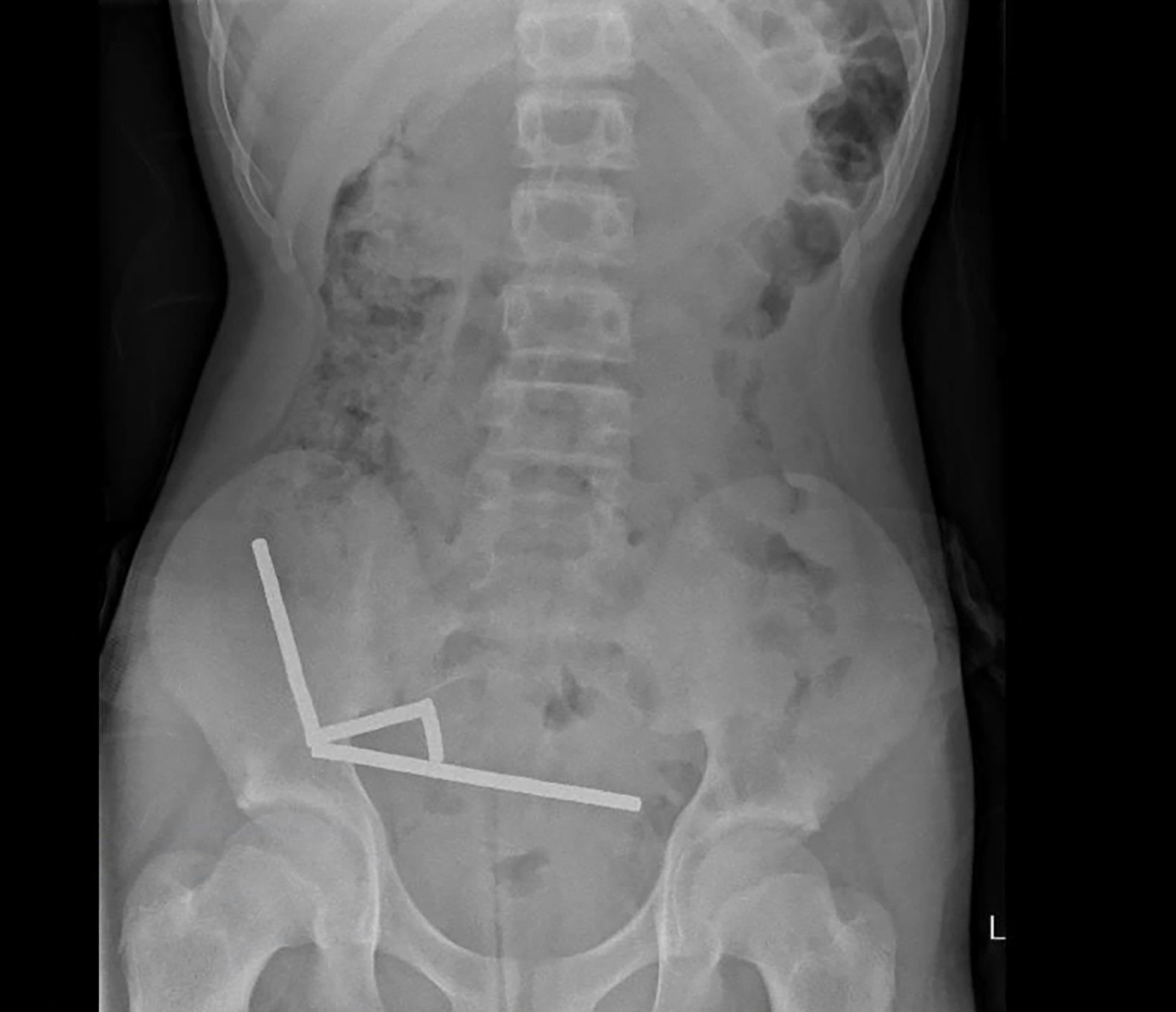 An X-ray image shows pieces of magnets stuck together in the intestines of a New Zealand teenager. Photo: New Zealand Medical Journal via AFP