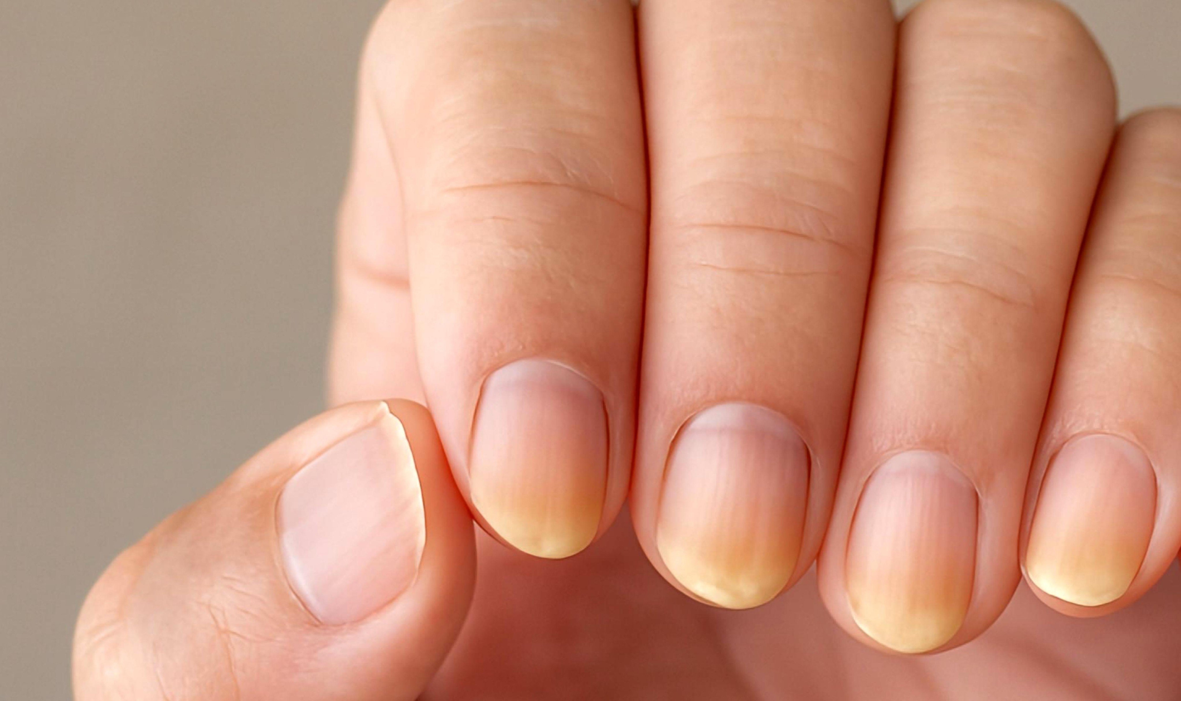 Pale or blue-tinged nails can suggest circulation issues, while yellowing nails, like these pictured, may point to fungal concerns. Photo: Shutterstock