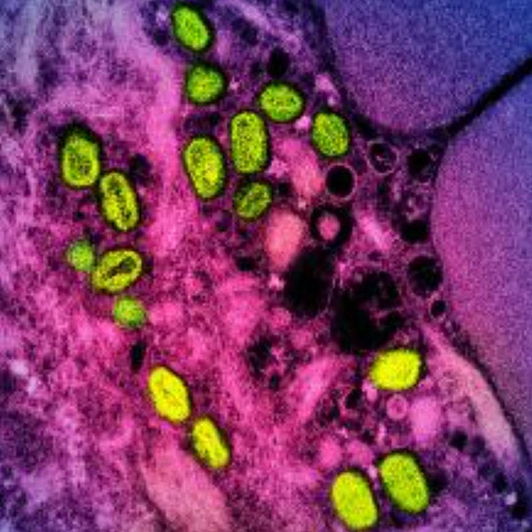 A colorised electron micrograph shows green mpox particles within a pink and purple infected cell cultured in a lab. Photo: National Institute of Allergy and Infectious Disease/AFP