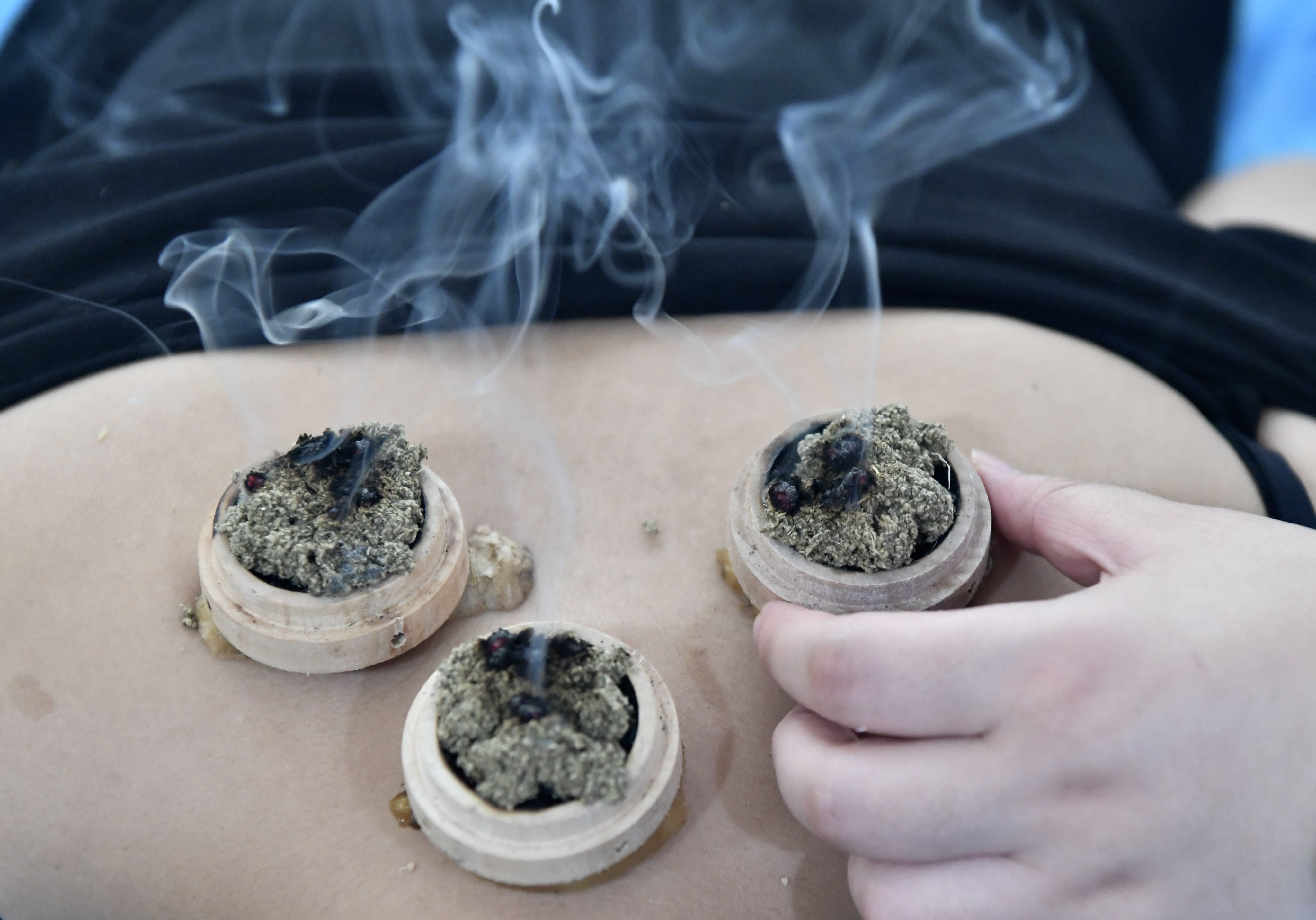 Dried mugwort leaves are burned on or near the skin’s surface in the traditional Chinese medicine treatment of moxibustion, a form of heat therapy used to relieve joint pain, indigestion and menstrual cramps, and even to treat infertility. Photo: China News Service via Getty Images