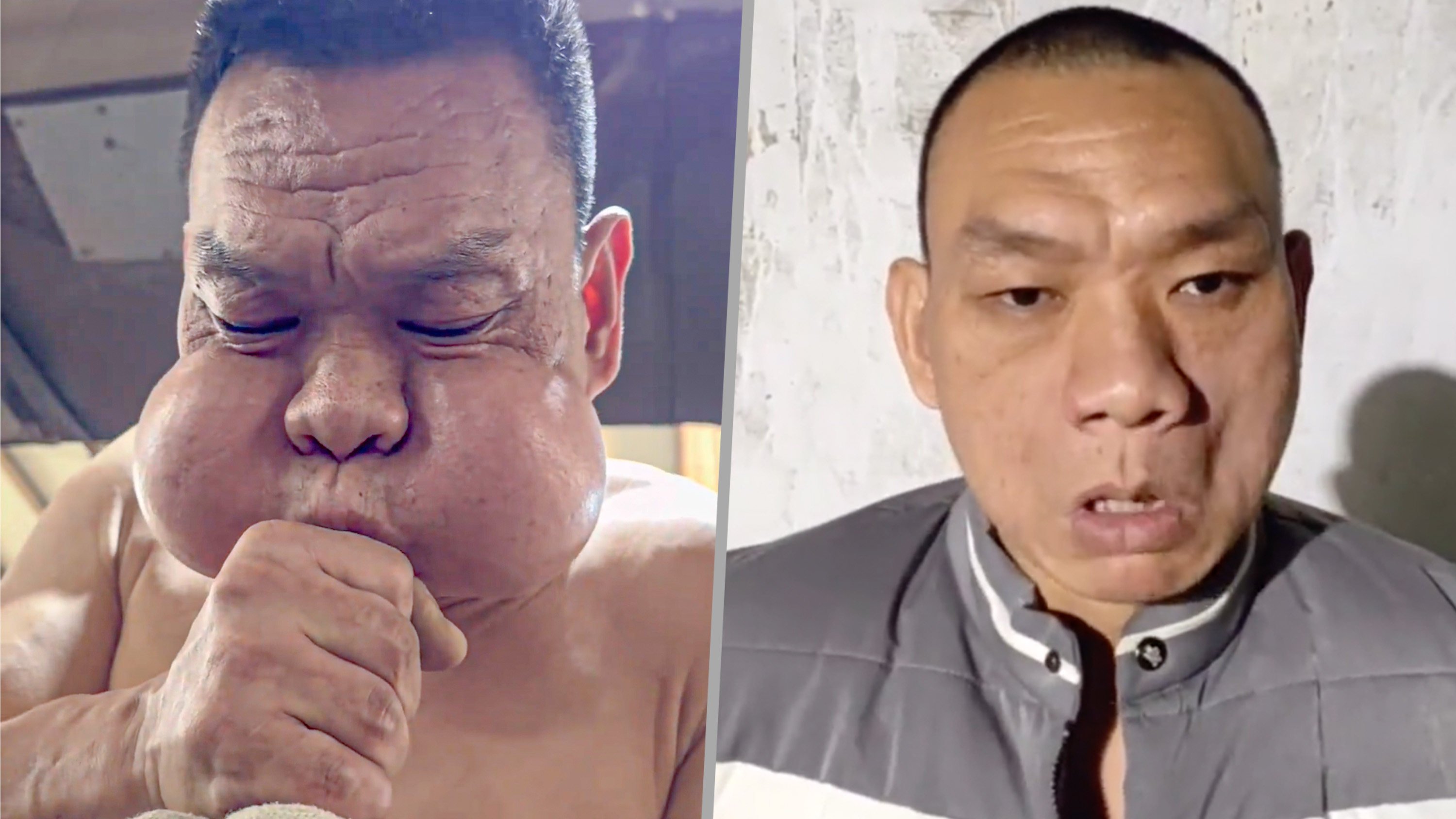 A glassblower in China has become known as the “frog prince” after 30 years of work left his cheeks unusually protruded. Photo: Douyin