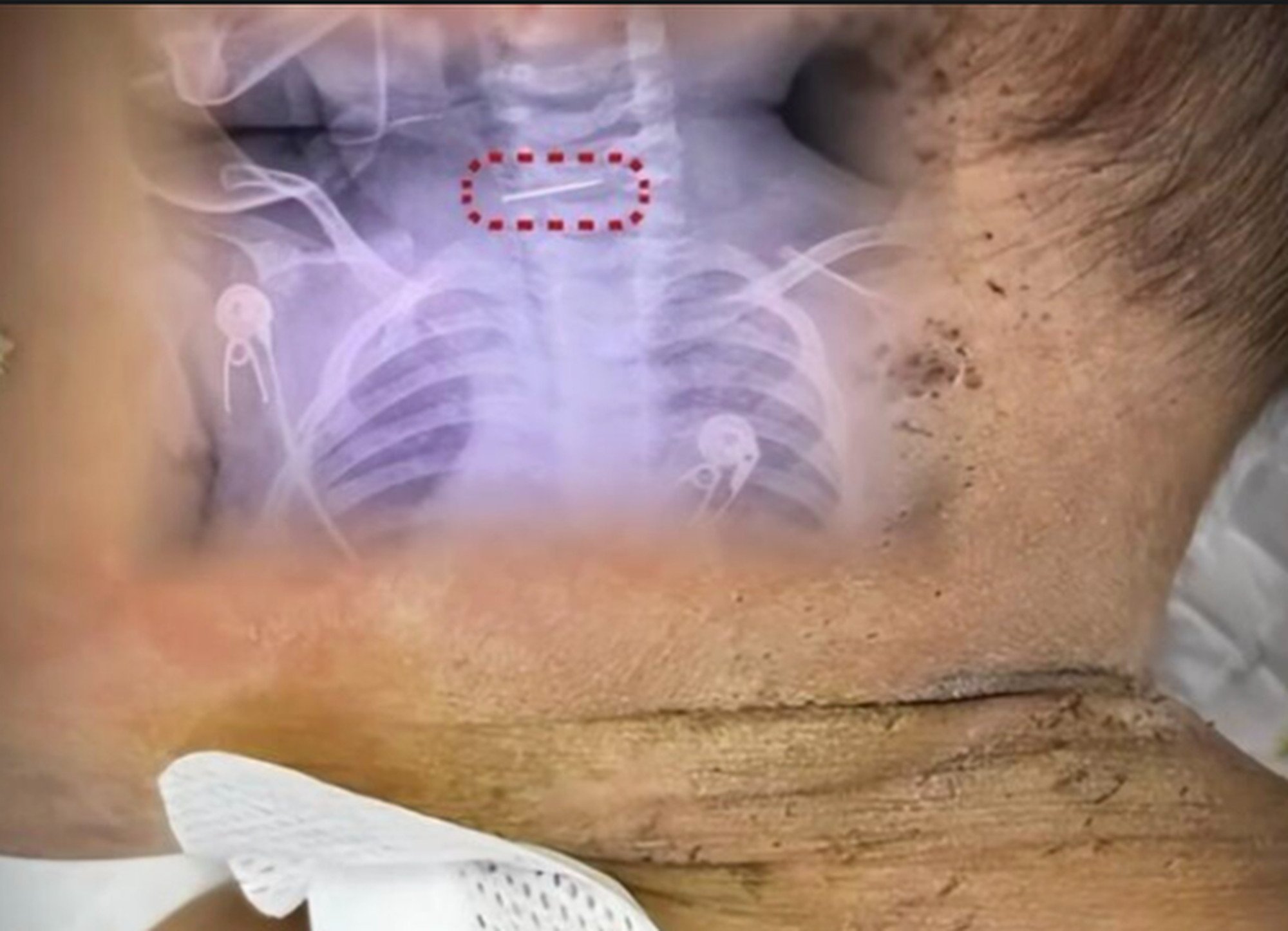 Stab marks can be seen on the child’s neck above. He had to undergo careful surgery to remove part of a broken needle from under his skin. Photo: QQ.com Stab marks can be seen on the child’s neck above. He had to undergo careful surgery to remove part of a broken needle from under his skin. Photo: QQ.com