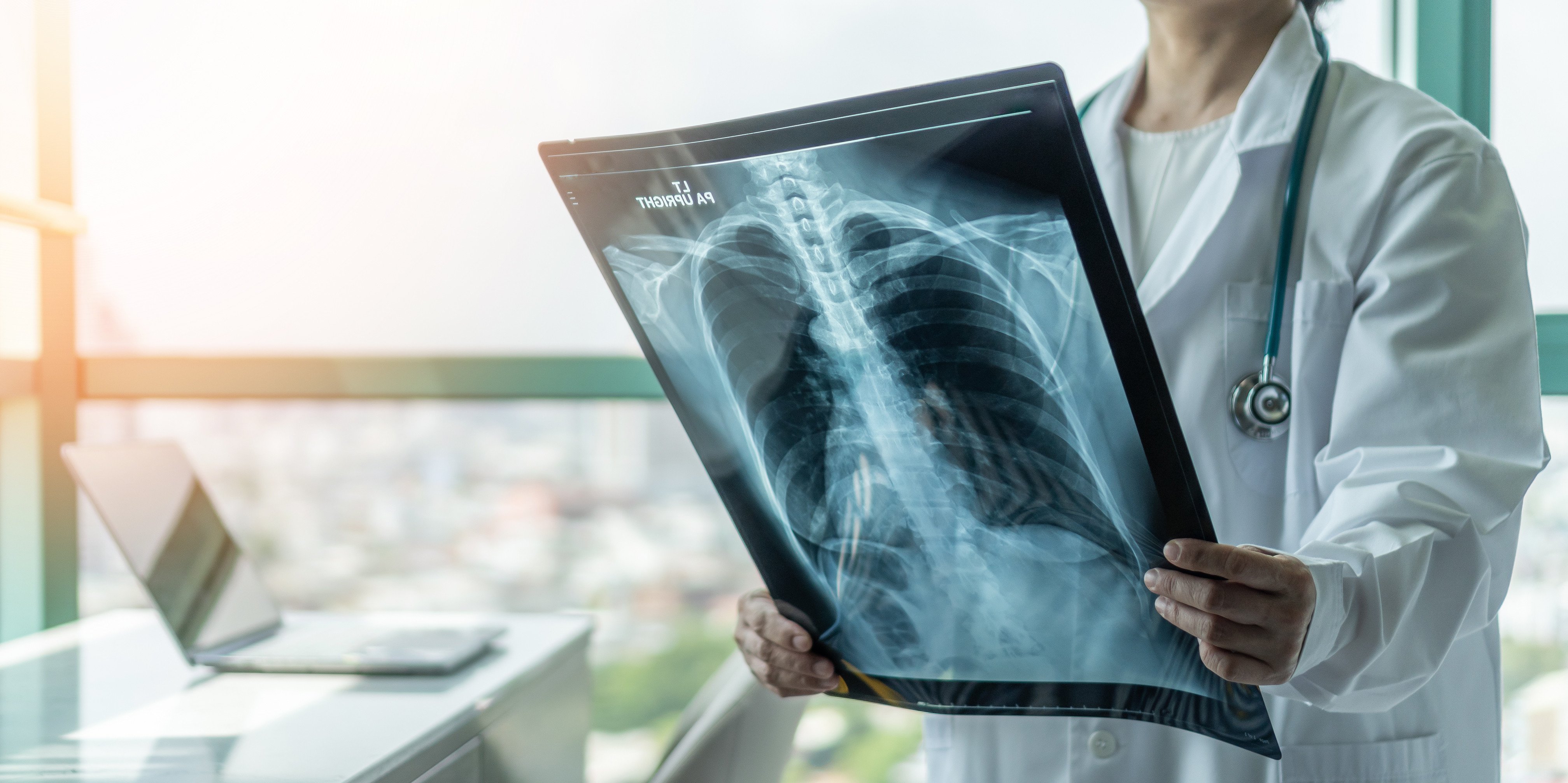 A doctor looking at an X-ray for signs of lung disease, such as  tuberculosis. Photo: Shutterstock