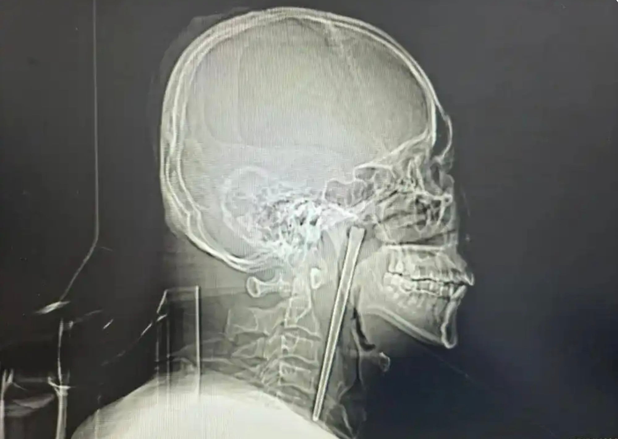 An X-ray photograph shows the metal object lodged in the man’s throat. Photo: baijiahao.baidu.com An X-ray photograph shows the metal object lodged in the man’s throat. Photo: baijiahao.baidu.com