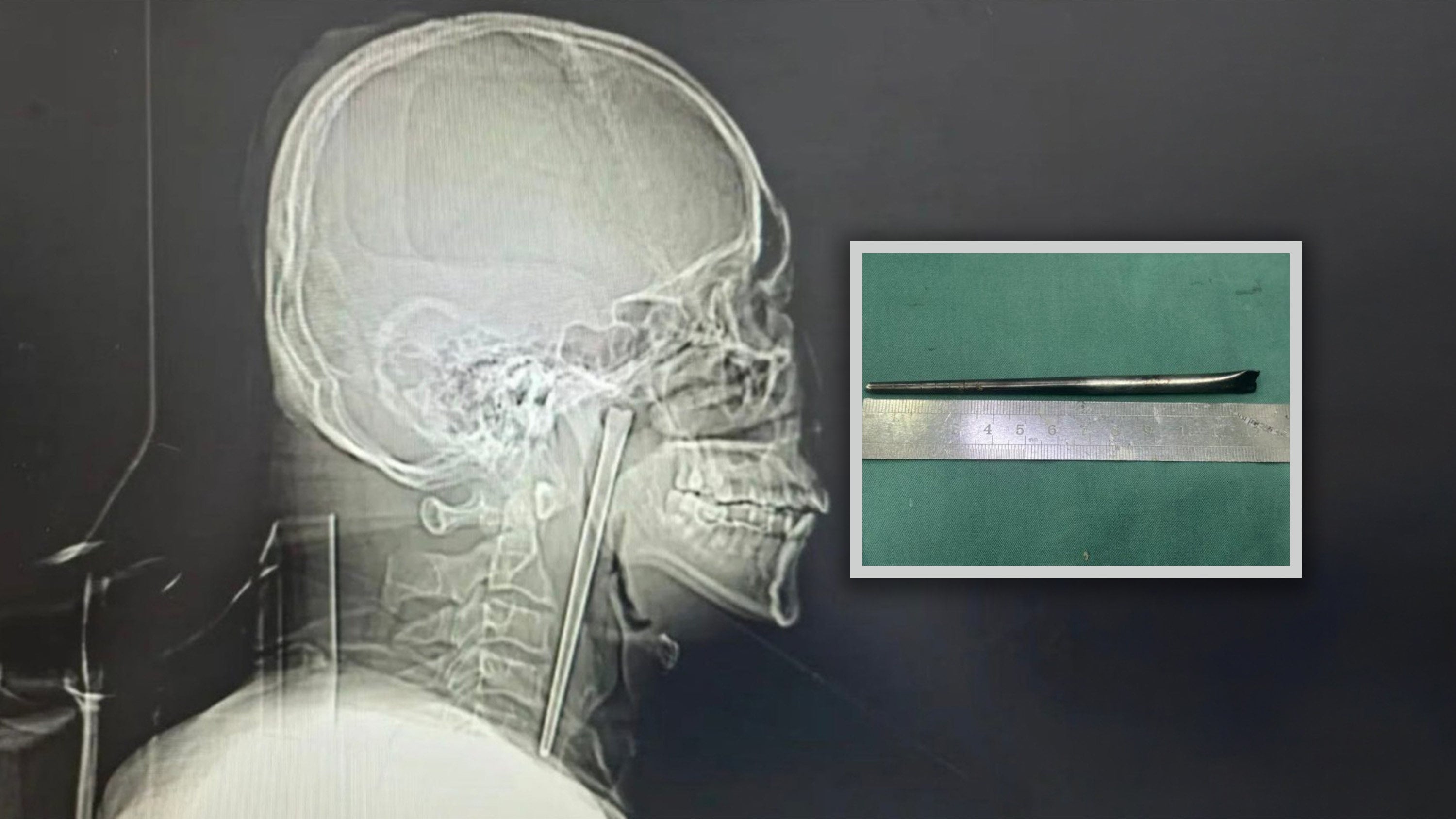 A Chinese man lived for eight years with a 12-cm-long chopstick stuck in his throat after accidentally swallowing it. Photo: SCMP composite/Weibo