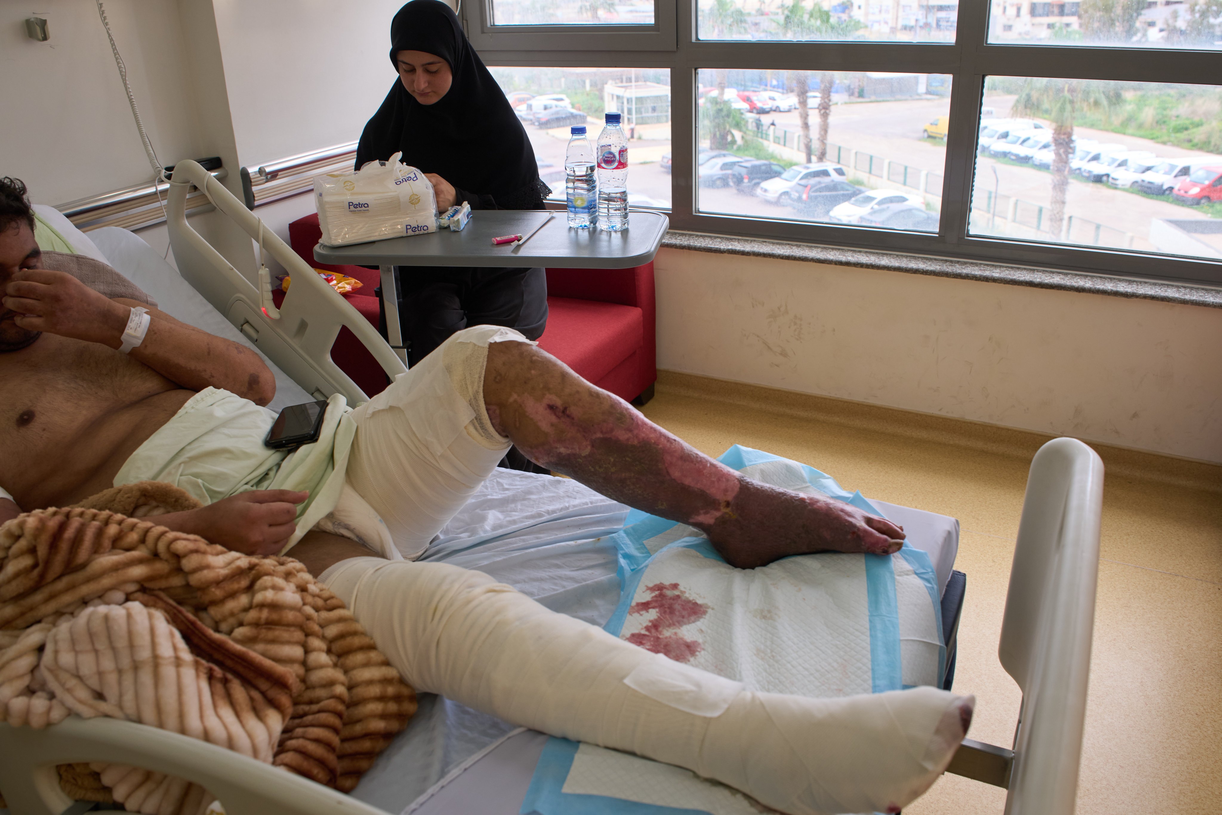 A man with burn wounds from an Israeli airstrike on southern Lebanon in a hospital bed on Thursday. Photo: AP