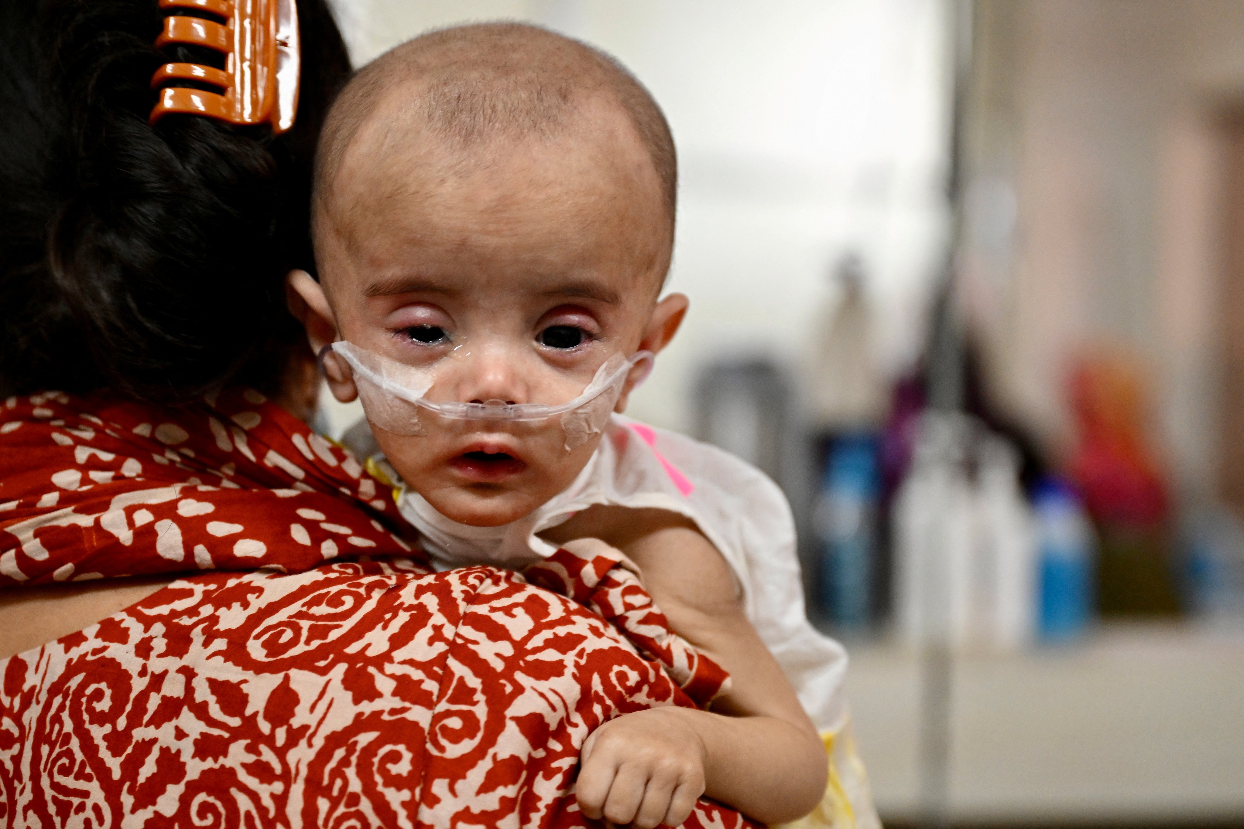 A child diagnosed with measles receives treatment inside a paediatric ward at the Bangladesh Shishu hospital  in Dhaka on April 7, 2026. (Photo by MUNIR UZ ZAMAN / AFP)