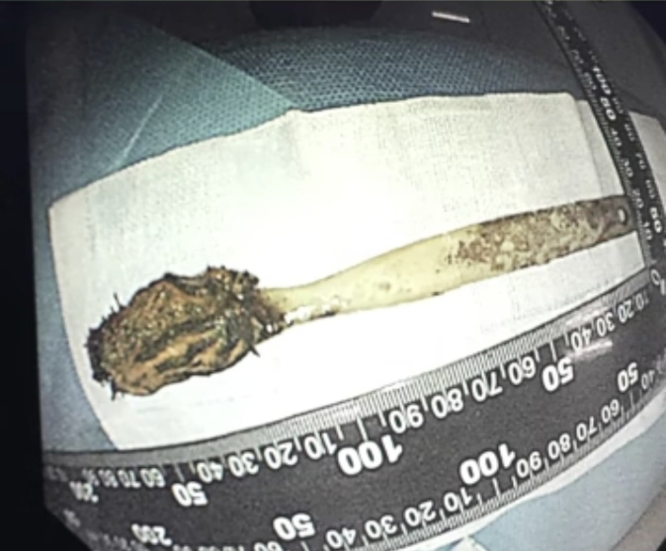 In a separate case last year, a man had a toothbrush removed that had been stuck in his intestines for 52 years. Photo: Douyin