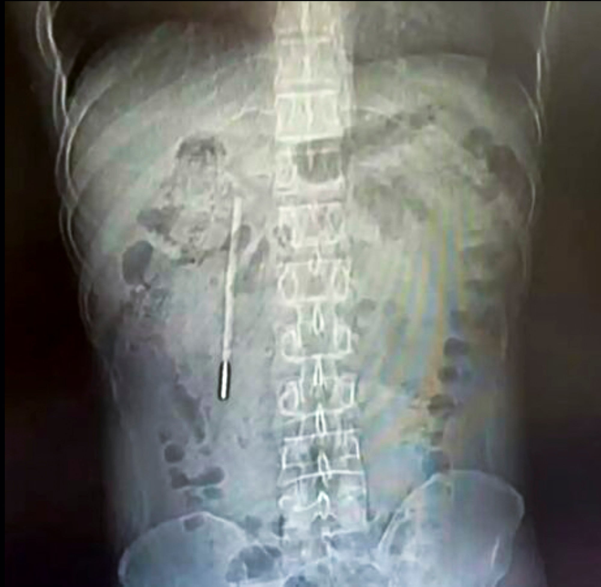 An X-ray image, above, shows the thermometer lodged inside Wang’s body. Photo: Weibo