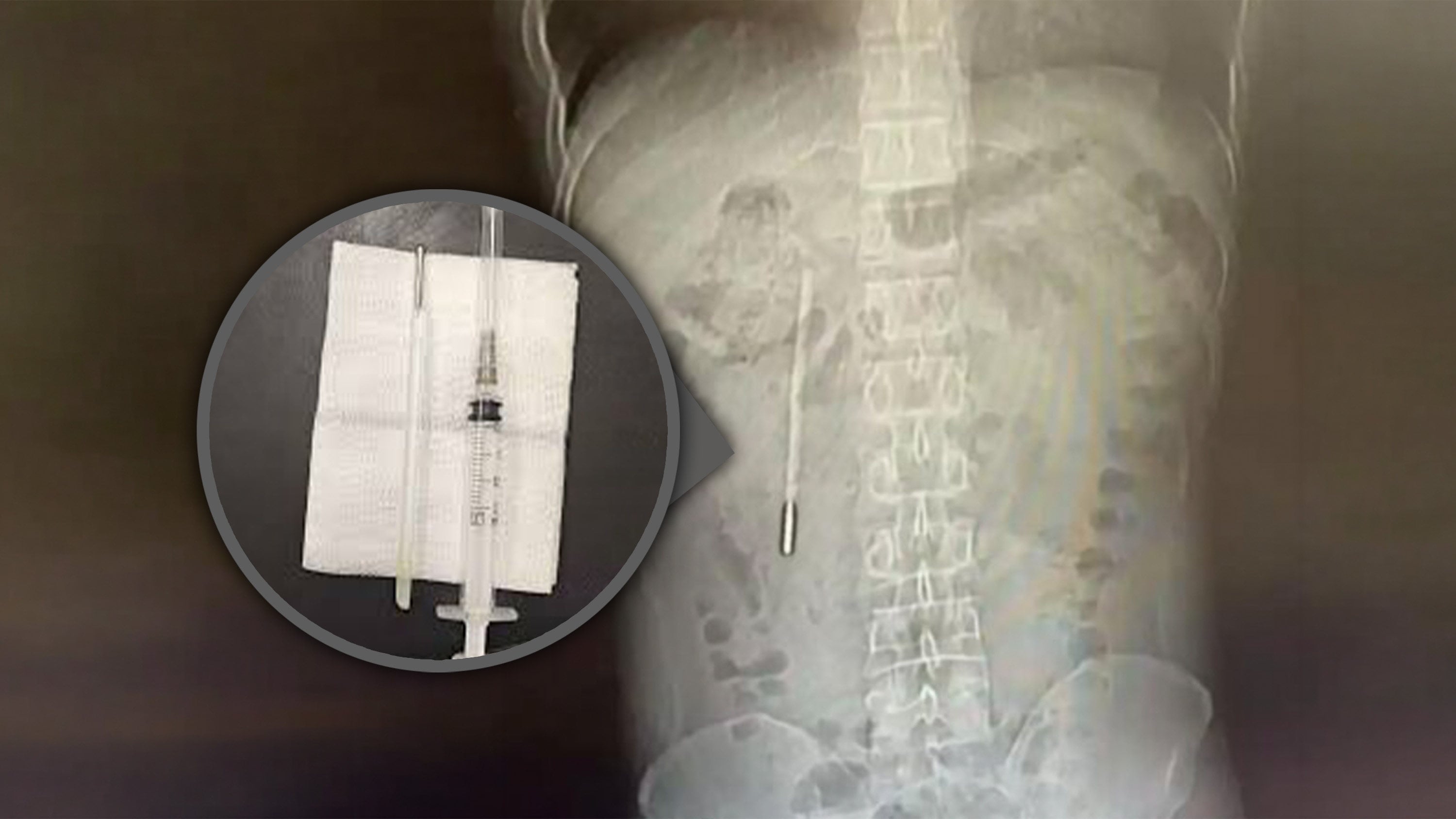 A 32-year-old Chinese man sought medical attention for stomach pain and was astonished to learn that a thermometer he had swallowed when he was 12 years old had remained inside him for 20 years. Photo: SCMP composite/Weibo