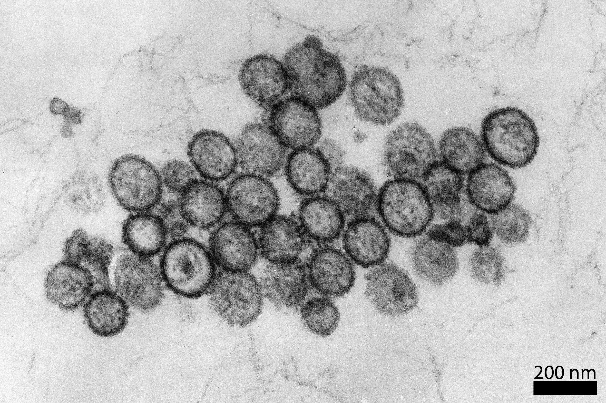 Early signs of the virus include flu-like symptoms such as fever, headaches and muscle pain. Photo: Hans R. Gelderblom/RKI/dpa