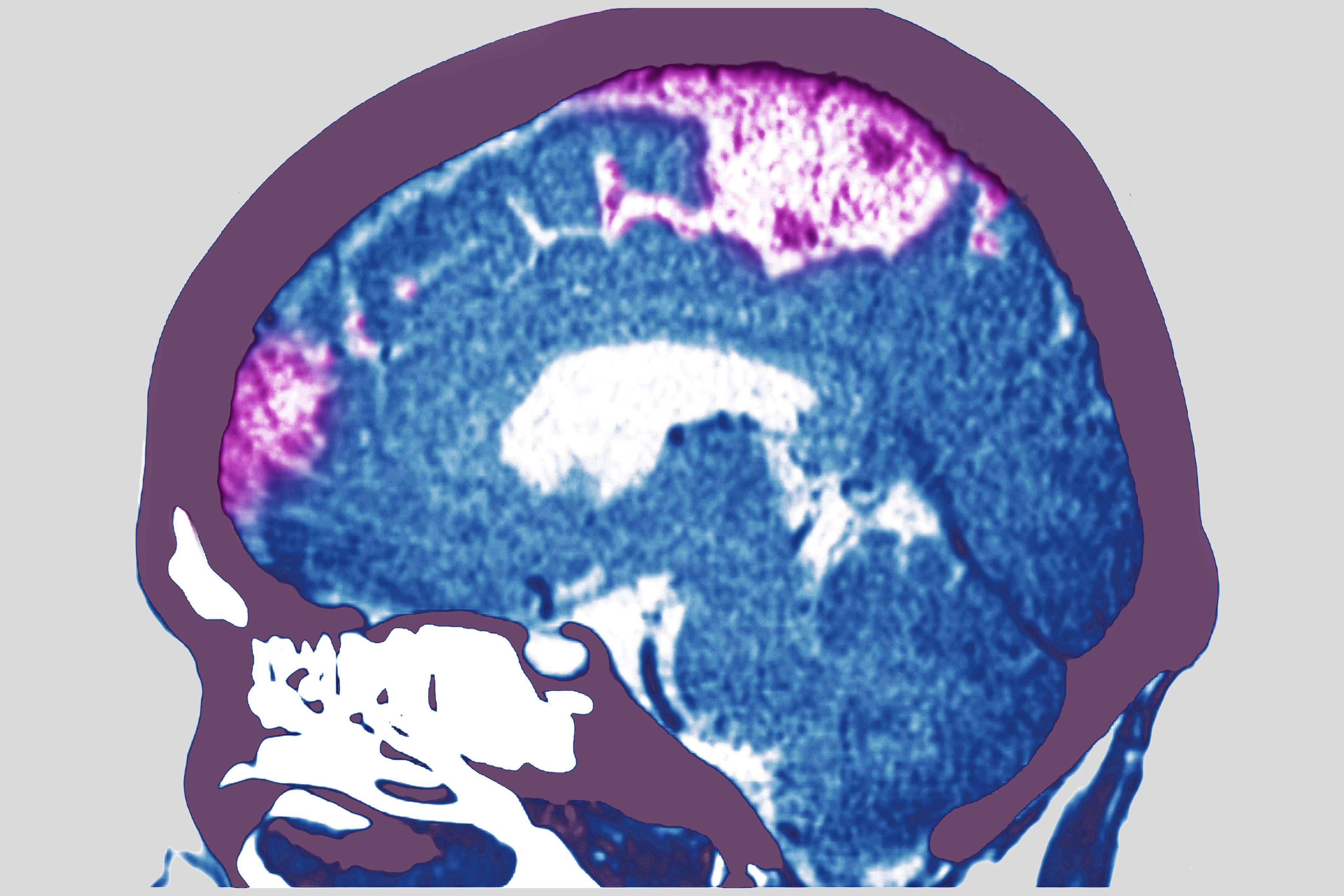 The research is the world’s first phase two clinical trial on the use of GLP-1 for stroke treatment. Photo: Getty Images