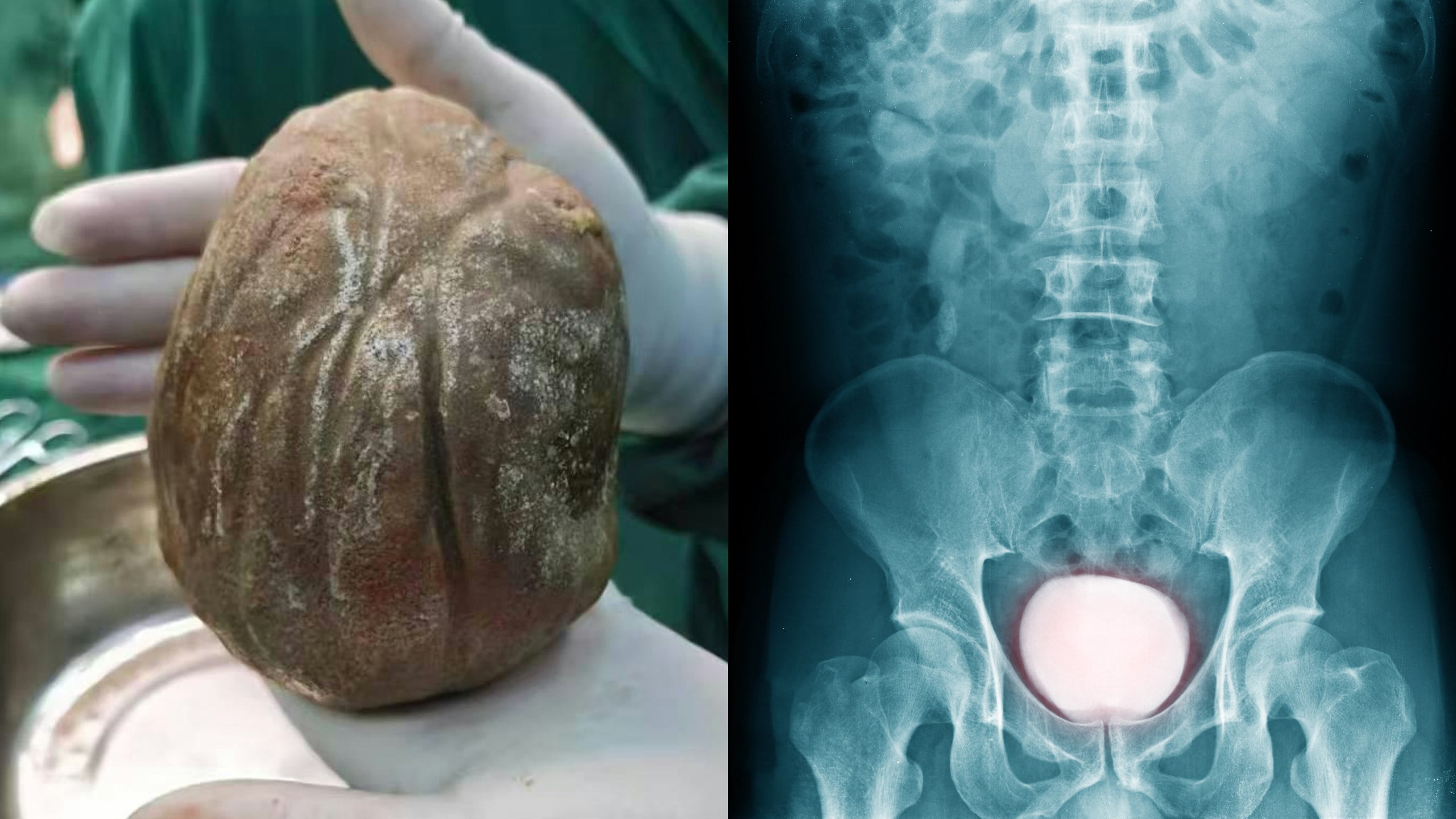 A Chinese man suffering from frequent pain during urination for three years finally discovered a massive 1.3kg bladder stone, shown above alongside a reference X-ray illustrating the condition. Photo: Handout/Shutterstock