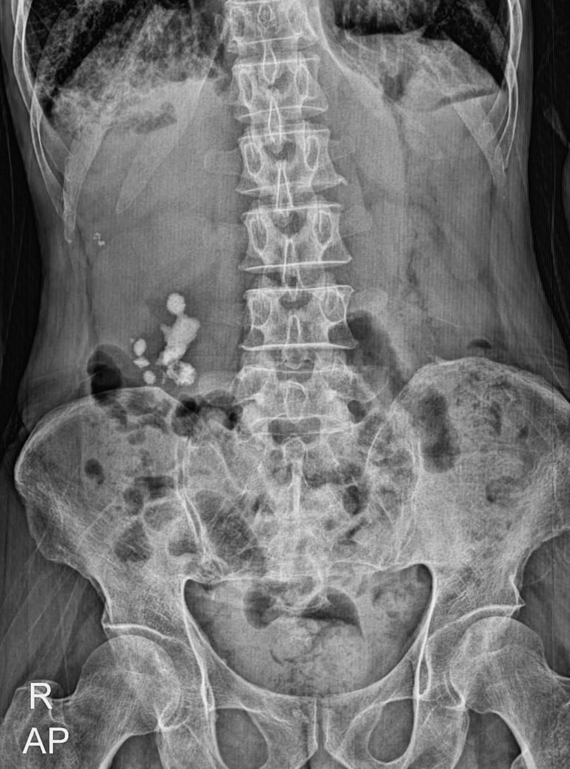 An X-ray of the urinary tract shows that the patient in a separate case has stones in their right kidney. Photo: Shutterstock An X-ray of the urinary tract shows that the patient in a separate case has stones in their right kidney. Photo: Shutterstock