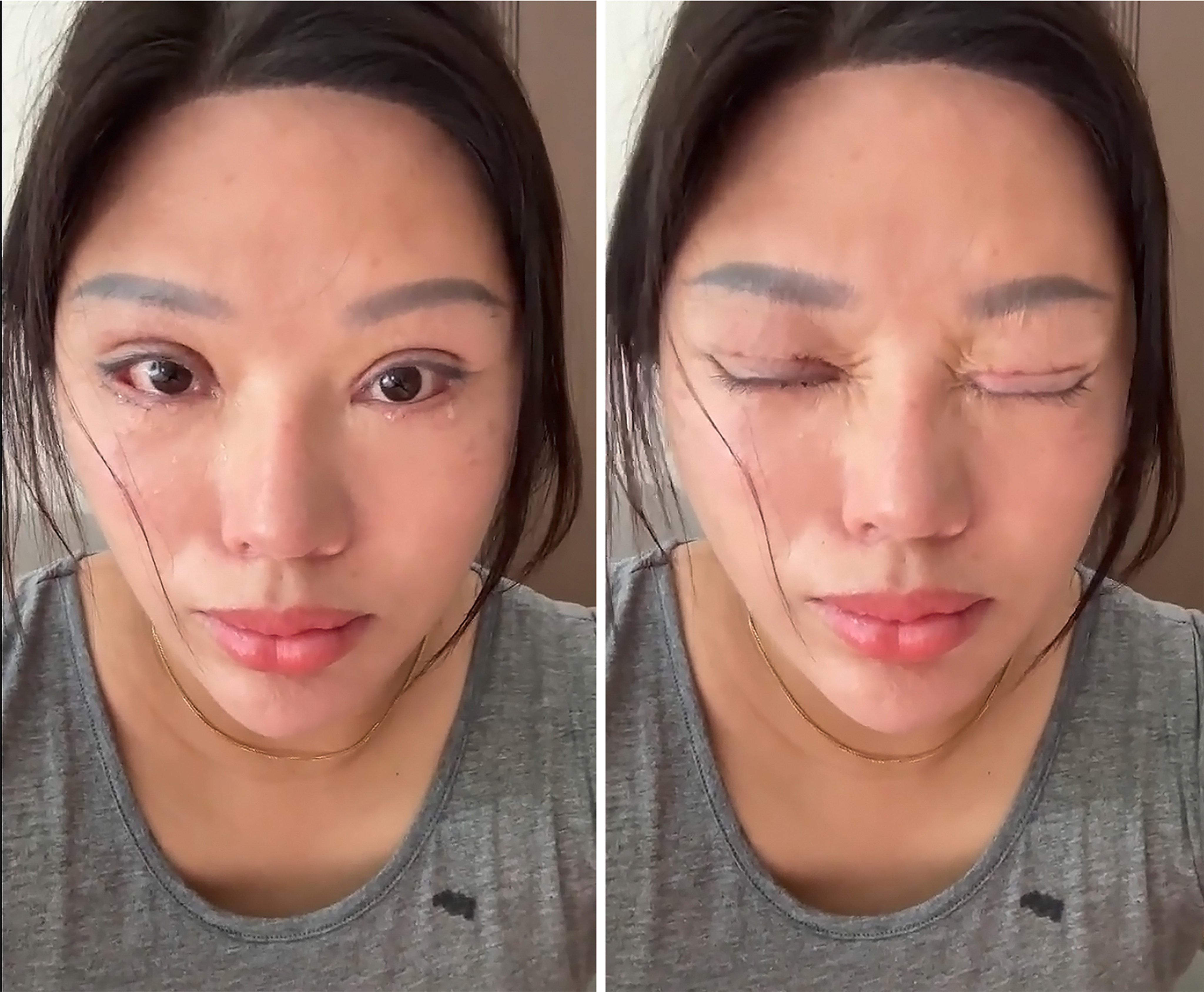 A woman from China had double eyelid surgery five years ago which led to severe complications and a bitter legal battle. Photo: Weibo