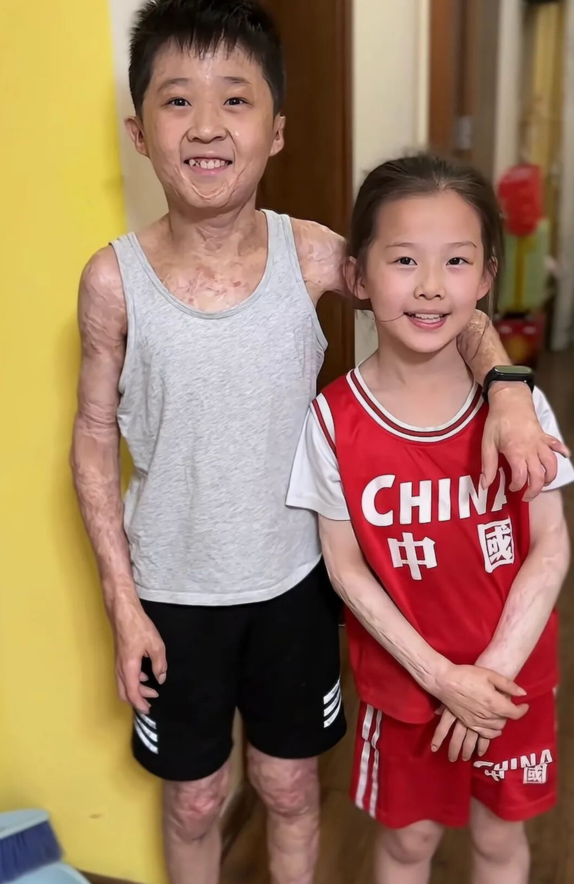 Xuanxuan’s injuries are clear to see, above, in a photograph with his sister. Photo: cbgc.scol.com.cn Xuanxuan’s injuries are clear to see, above, in a photograph with his sister. Photo: cbgc.scol.com.cn
