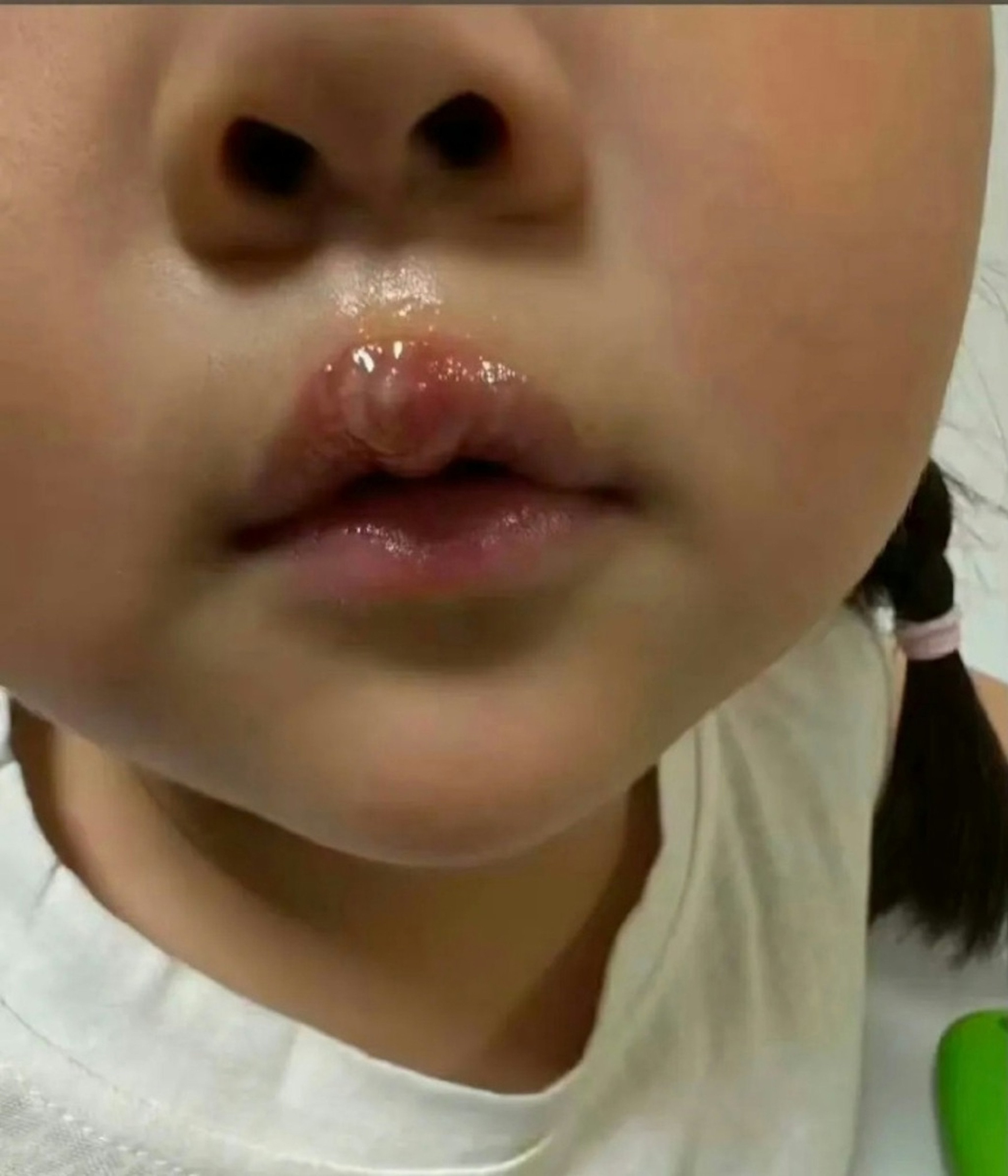 A teacher in China is under investigation after she used a glue gun to scald a little girl. Photo: Weibo