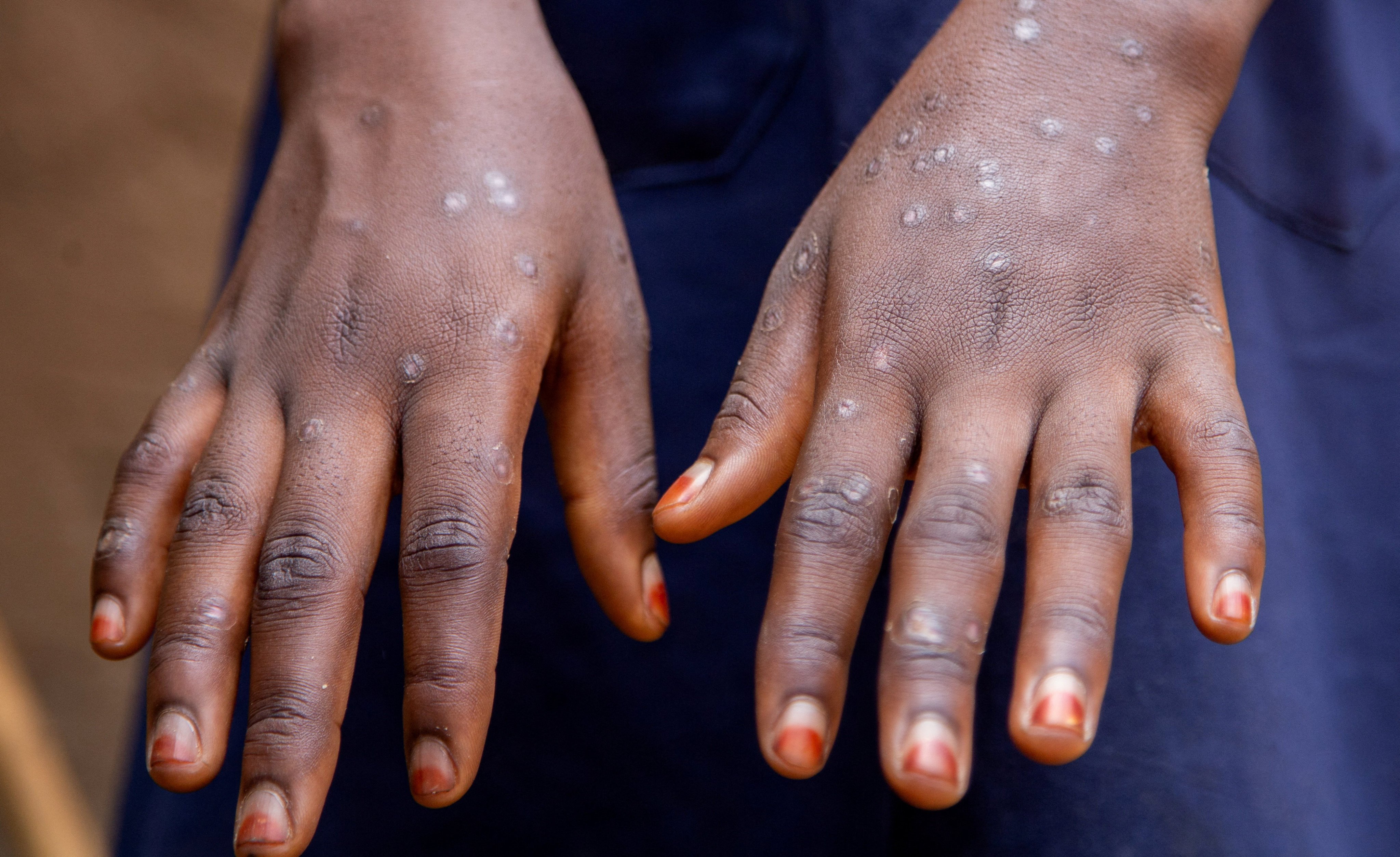 A woman in Burundi shows markings on her hands after contracting and recovering from Mpox. Photo: Reuters