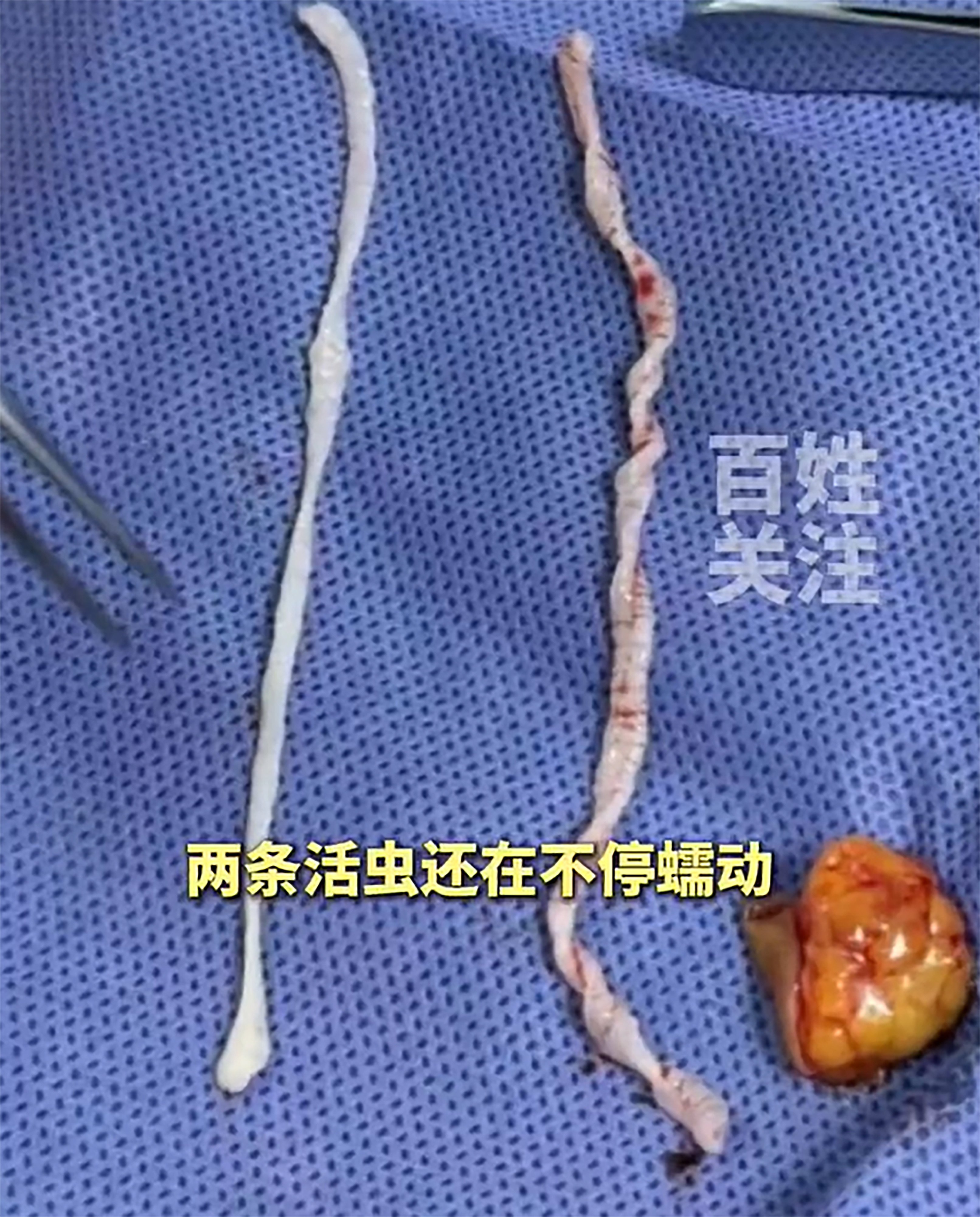 After enduring a painful, swollen lump in her arm for an entire year, a Chinese woman finally got relief when doctors surgically removed two live, 10-cm-long worms. Photo: Weibo