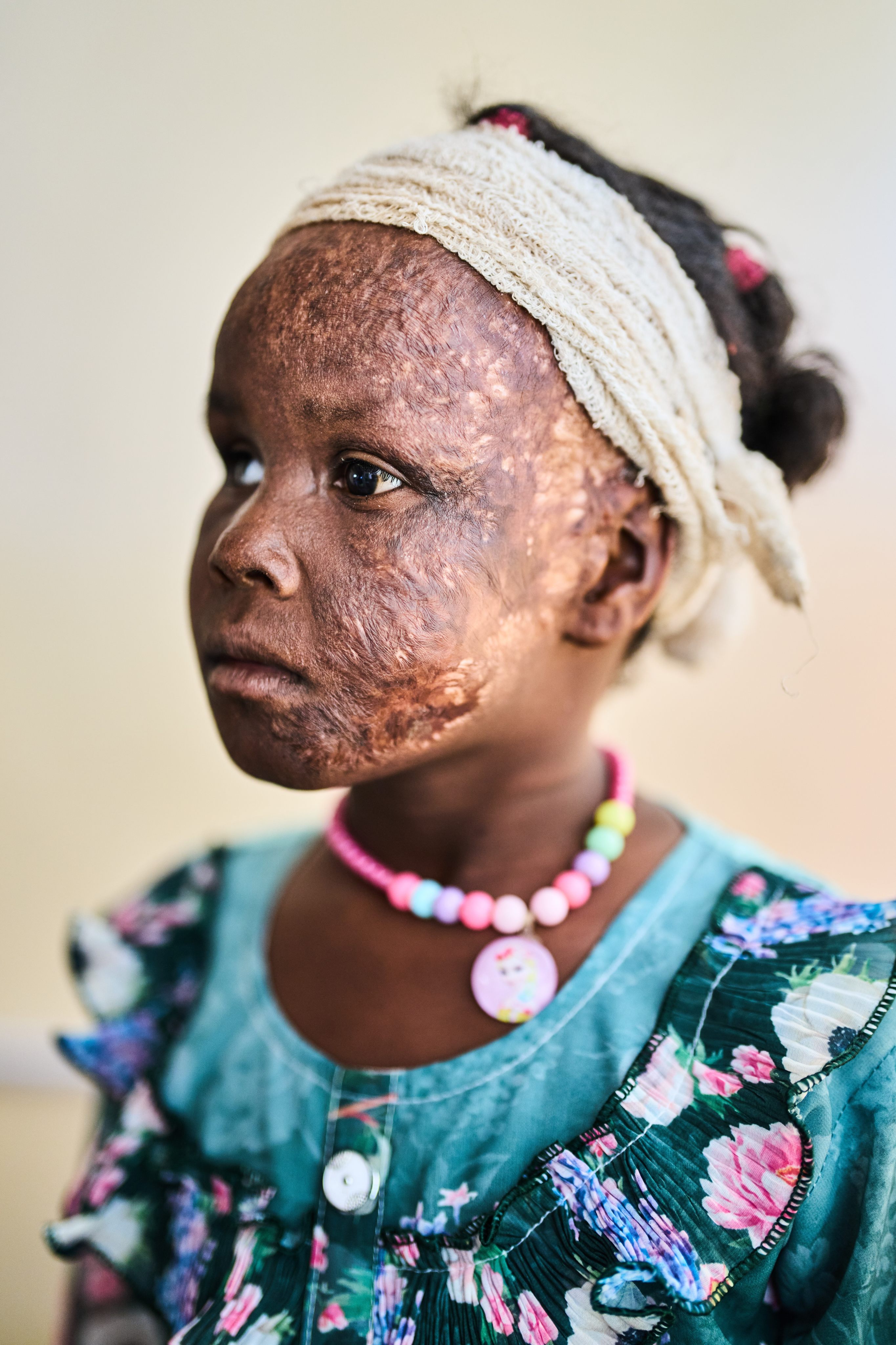 Zeinab Mujhed, aged eight, who was injured in a shelling attack, poses for a portrait in a hospital on the outskirts of Khartoum, Sudan, in April. Photo: AP