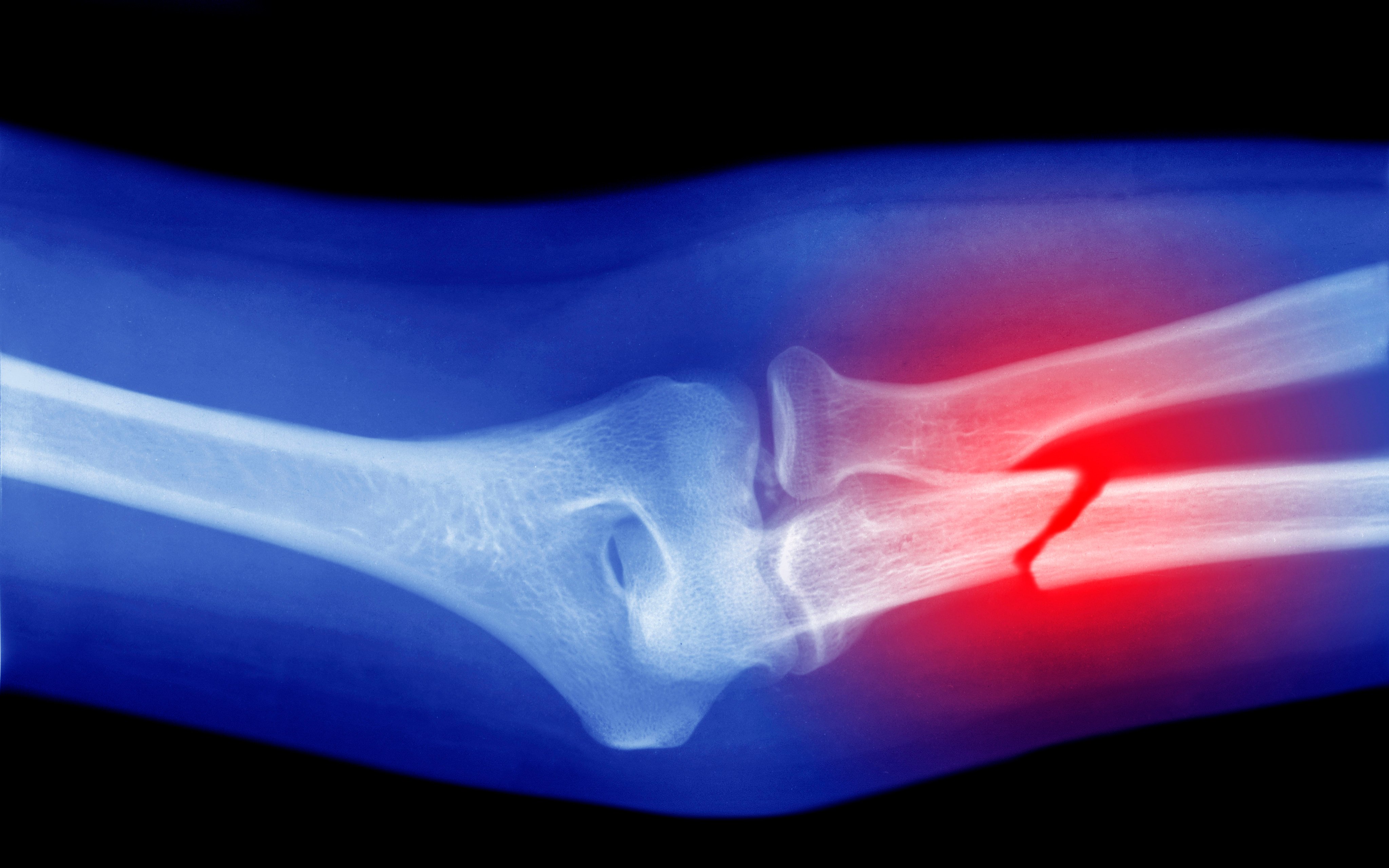 Osteoporosis affects about 30 per cent of women and 8 per cent of men aged 50 and older in Hong Kong. But up to 80 per cent of cases go undiagnosed and untreated. Photo: Getty Images