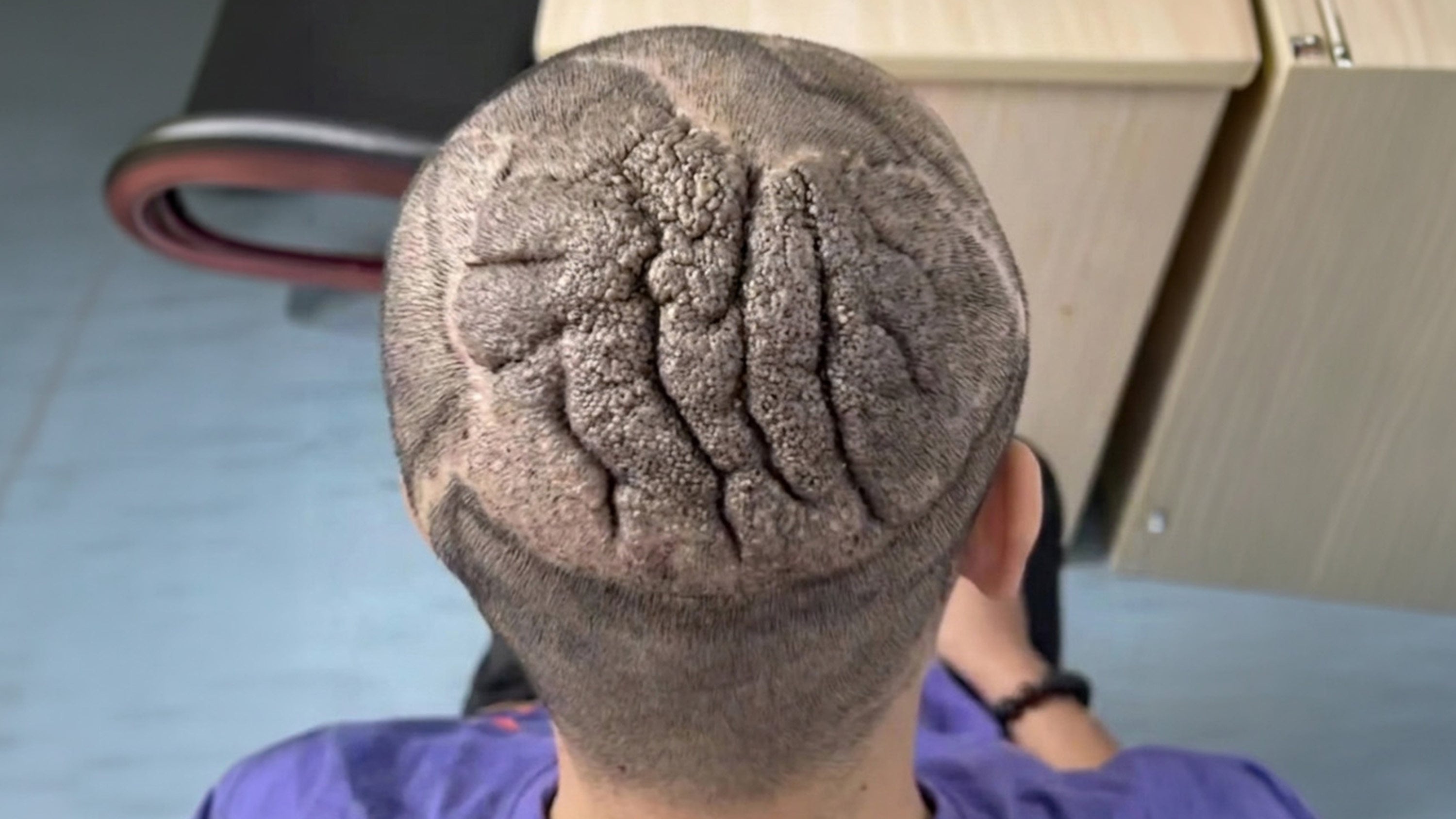 A young man from central China, whose scalp skin looked like the creases of a brain, had been bothered by his appearance for years before finding a solution. Photo: Douyin