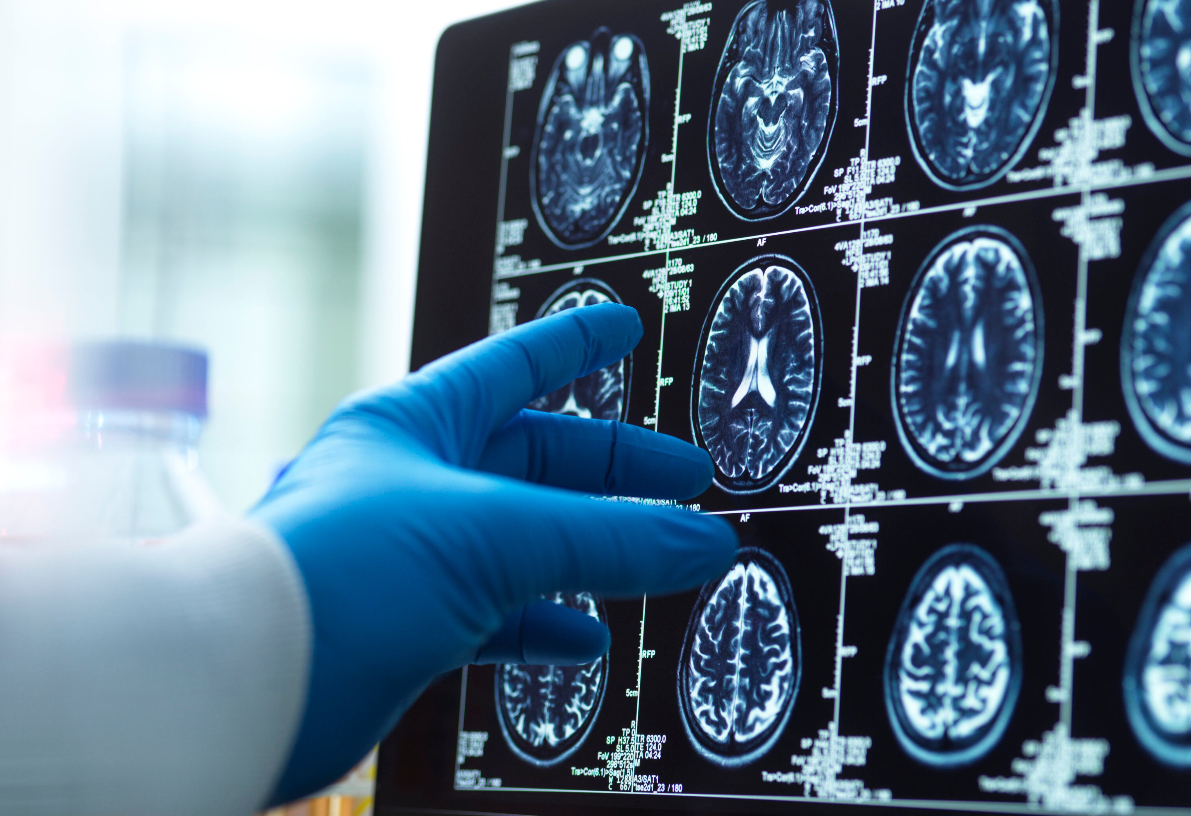 Alzheimer’s disease accounts for 60 to 70 per cent of all dementia cases worldwide. Photo: Getty Images