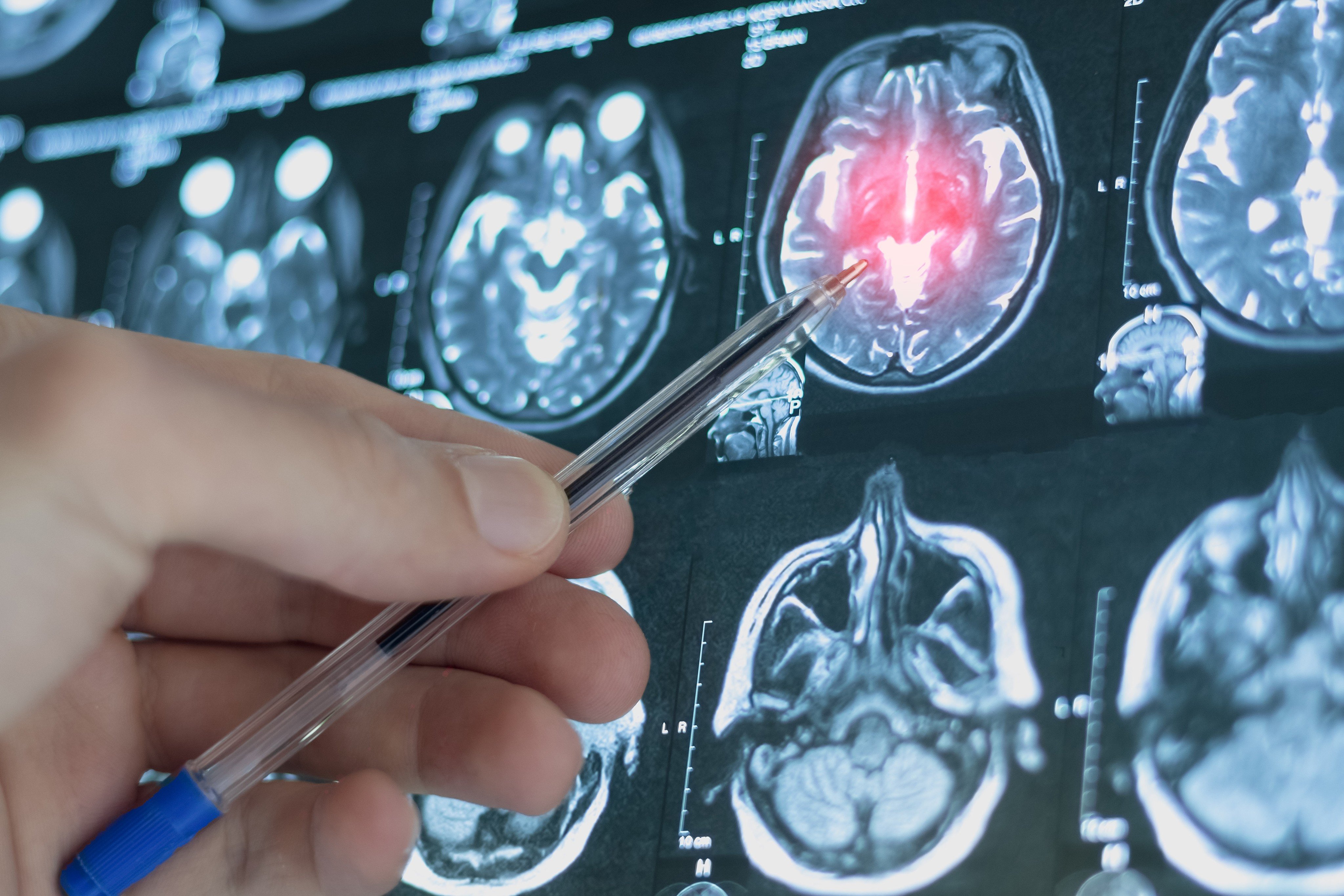 scmp.com - Shi Huang - Chinese brain-reading AI model may predict depression risk 4 years in advance