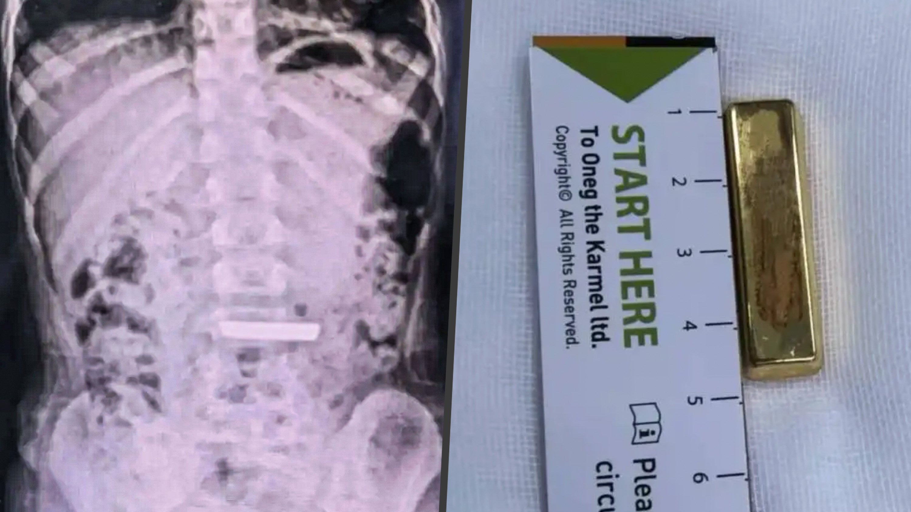 Doctors in China successfully removed a 50g gold bar from a five-year-old child, just hours after she accidentally swallowed it. Photo: SCMP composite/QQ.com