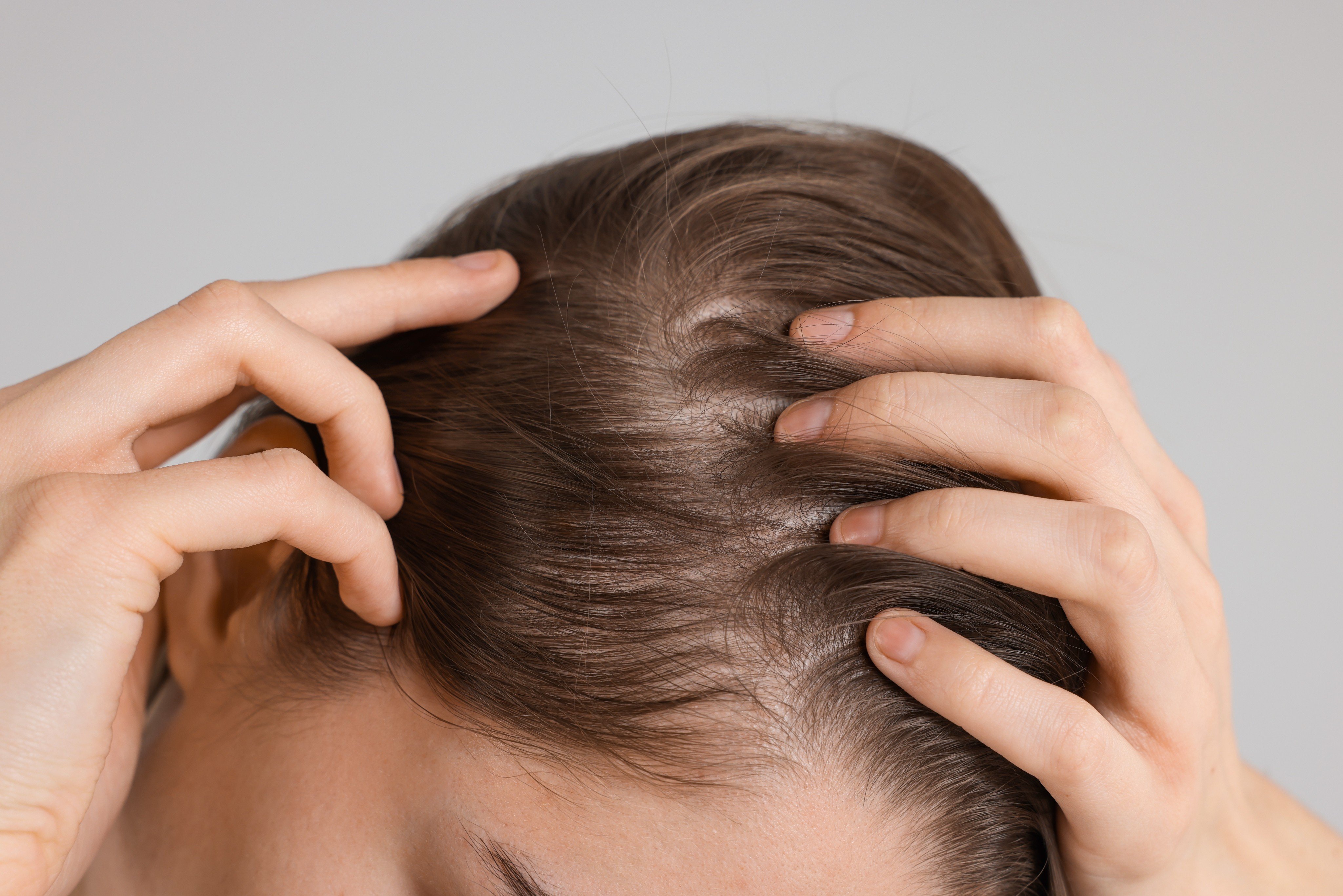 Alopecia areata is an autoimmune disease, where the body’s own immune system mistakenly attacks hair follicles. Photo: Shutterstock