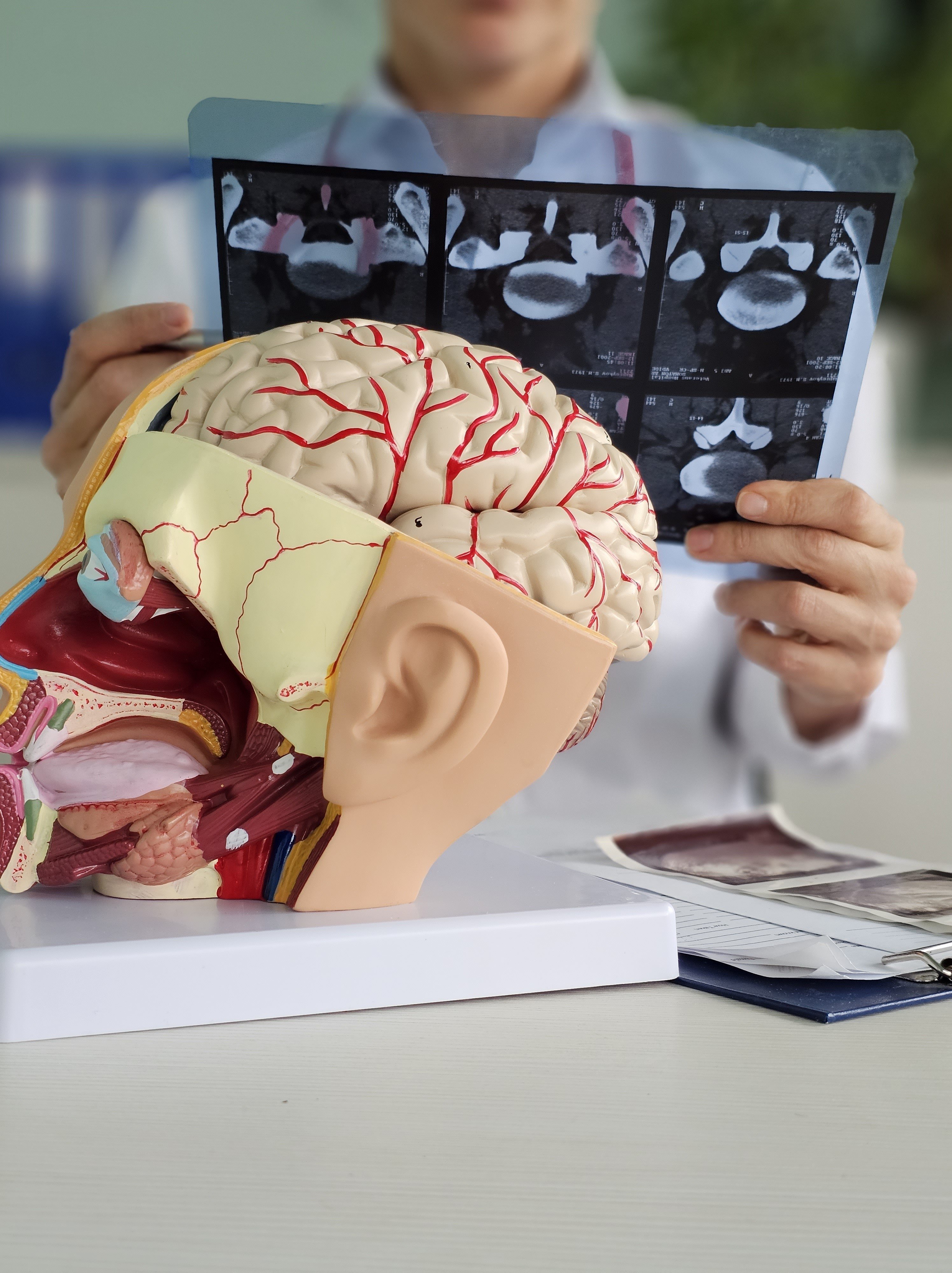 Focused ultrasound is being studied as a non-invasive way to target brain tumours including glioblastoma, an aggressive form of the disease. Photo: Shutterstock