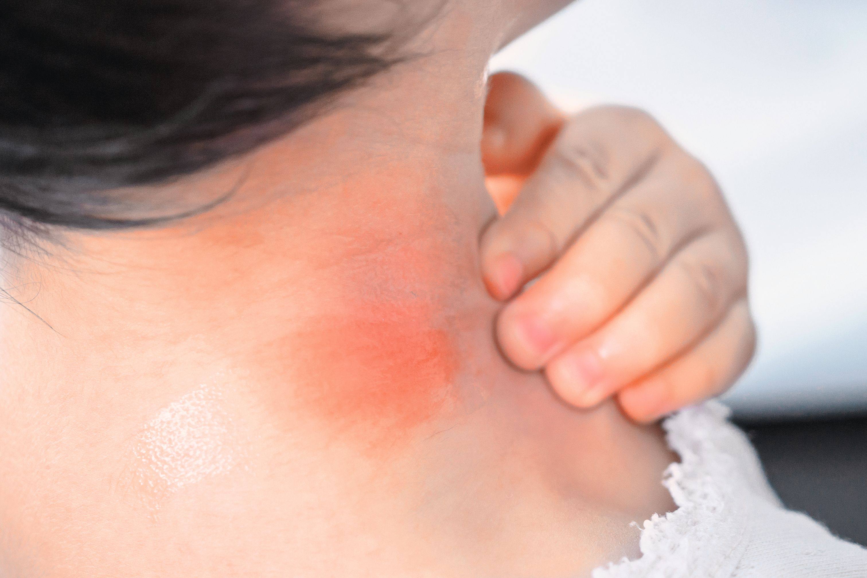Research revealed that scratching bug bites worsens inflammation, triggers mast cells and prolongs itching. Photo: Shutterstock