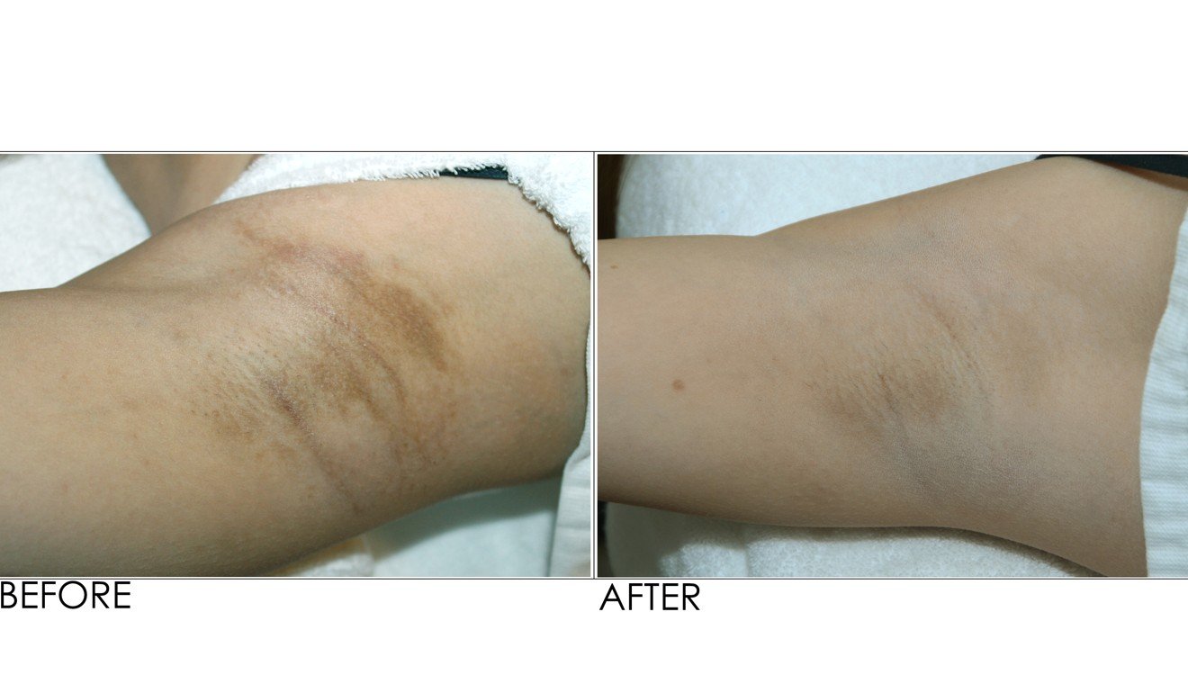 Another example of underarm whitening before (left) and after at Dr Belo’s clinic in Manila.