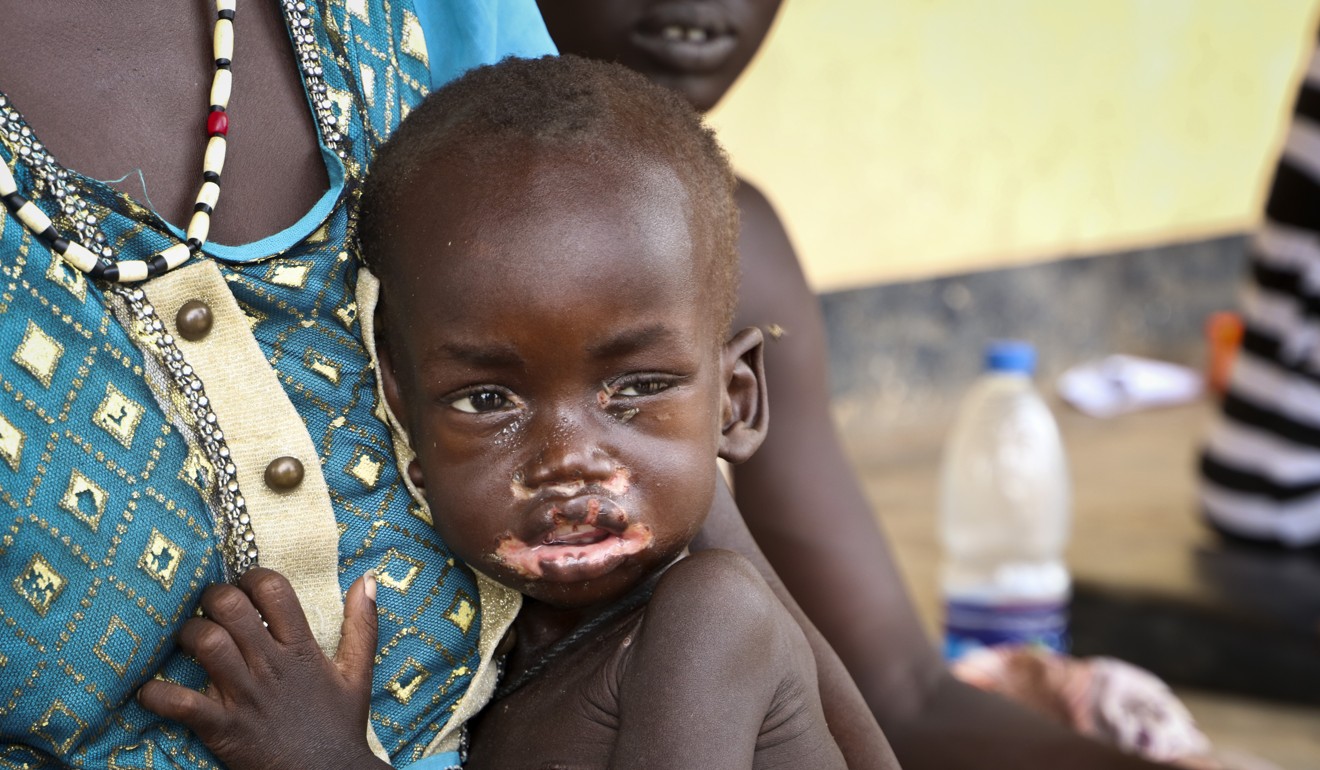 Agiu Nyang, who is sick with measles, sits on the lap of his mother Amel Makir at a hospital in Kuajok, South Sudan. Photo: AP