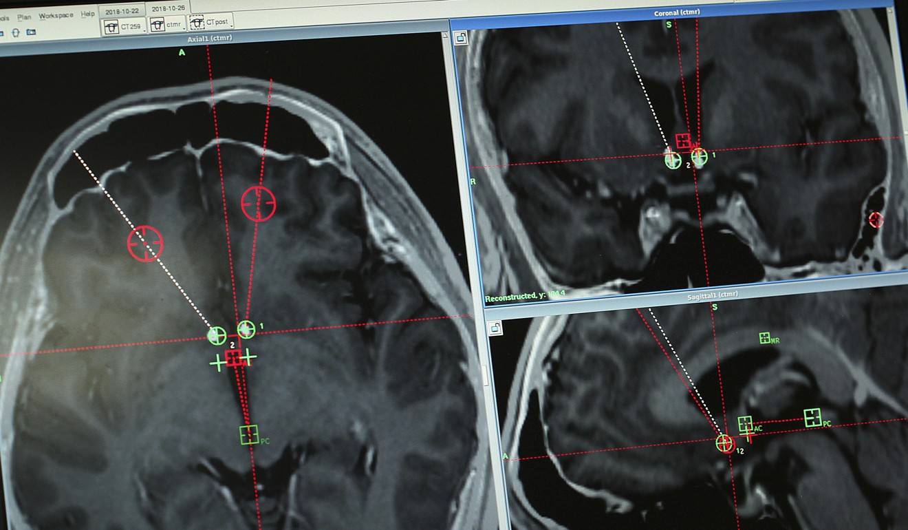 A brain scan of a methamphetamine addict with the path of electrodes that doctors had implanted to stimulate an area of the brain associated with addiction. Photo: AP