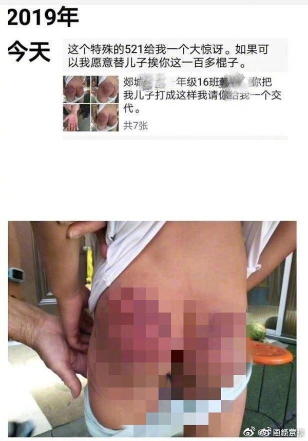 One of the boy’s parents posted pictures of his bruises on social media. Photo: Weibo