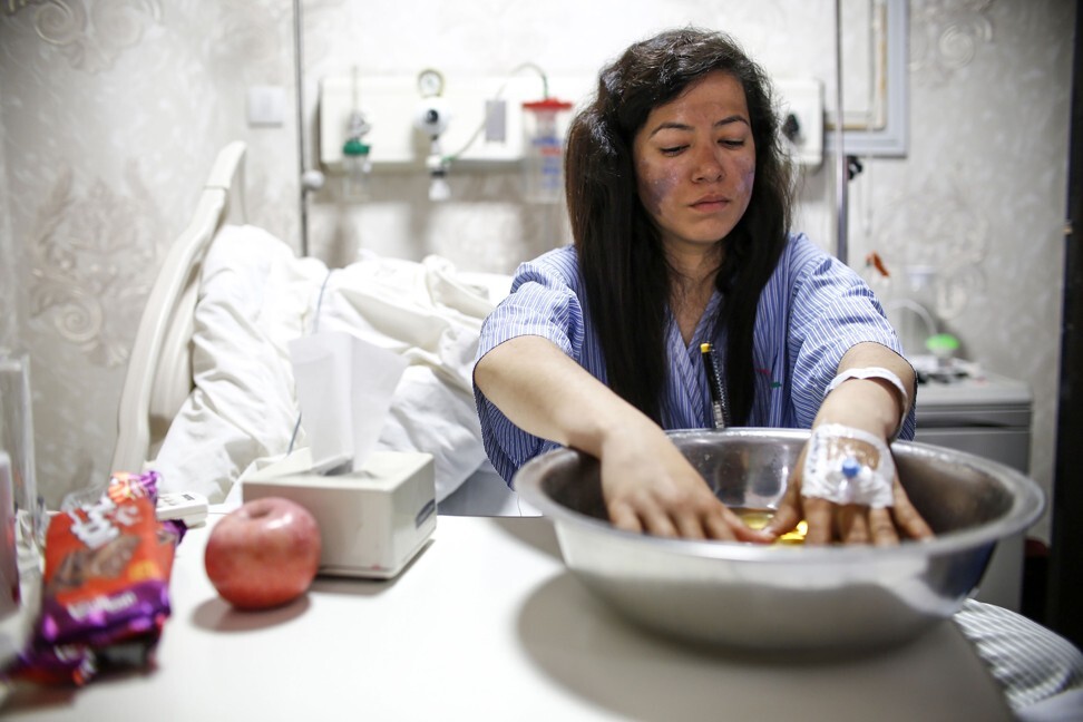 Ameesha Chauhan, who survived the Everest “traffic jam”, recovers from frostbite in a Kathmandu hospital. She believes climbers without basic skills should be barred from trying to summit the world’s highest peak. Photo: AFP