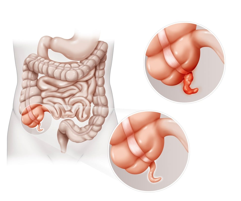 A medical drawing showing the position of the appendix on the intestines and what a swollen appendix (appendicitis) looks like. Photo: Alamy