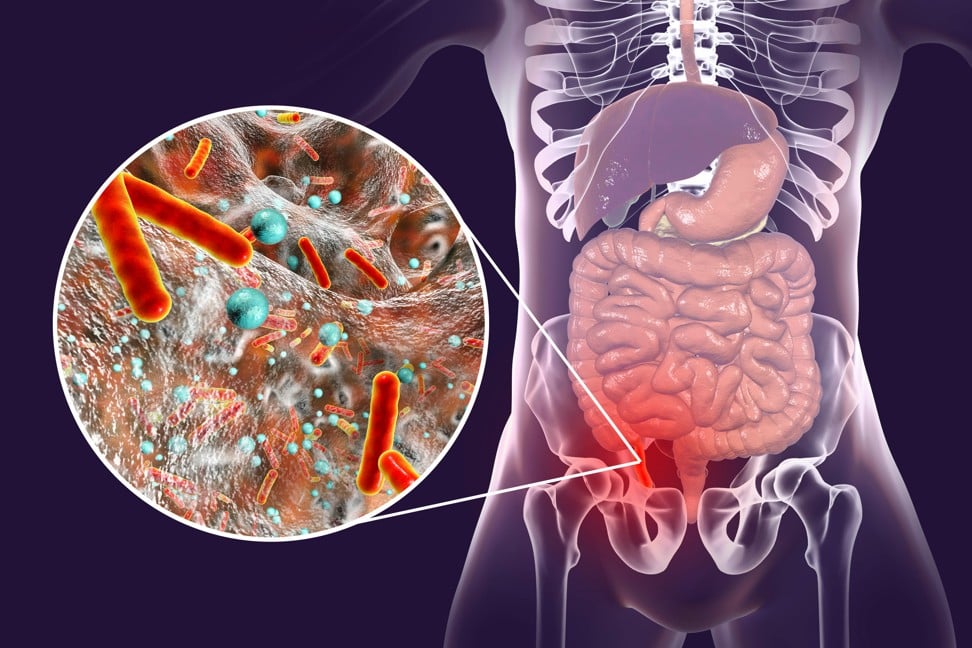 In inflamed human appendix and the most common microorganisms seen in acute appendicitis: E coli and Bacteroides fragilis. Less commonly found are, Klebsiella pneumoniae, various Streptococci and Enterococci, and Pseudomonas aeruginosa. Photo: Alamy