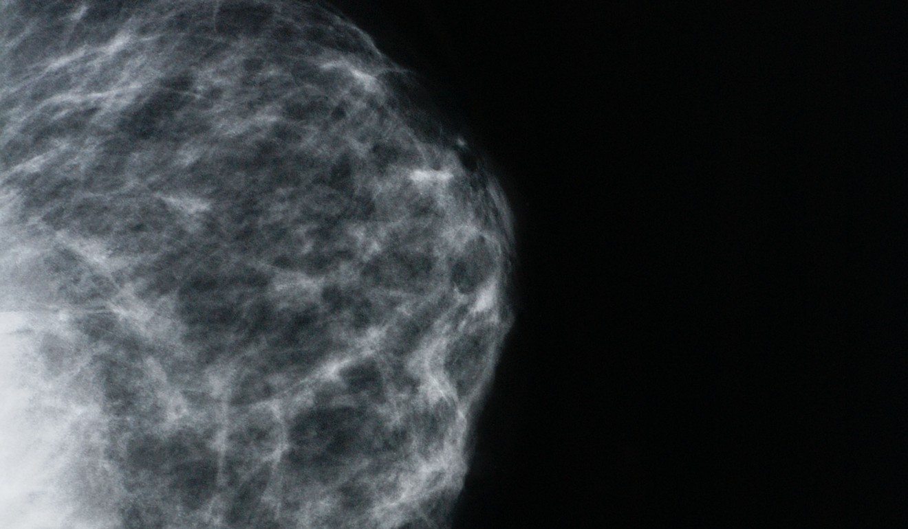 A mammography.