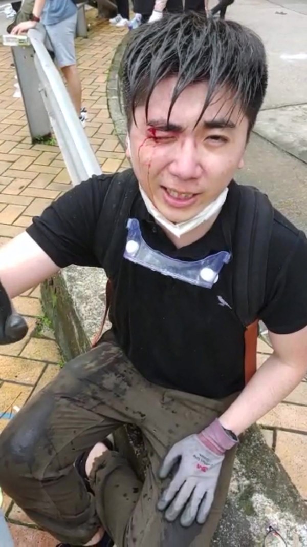 Diocesan Girls’ School teacher Raymond Yeung, who was injured above his right eye during the clashes on Wednesday. Photo: Handout